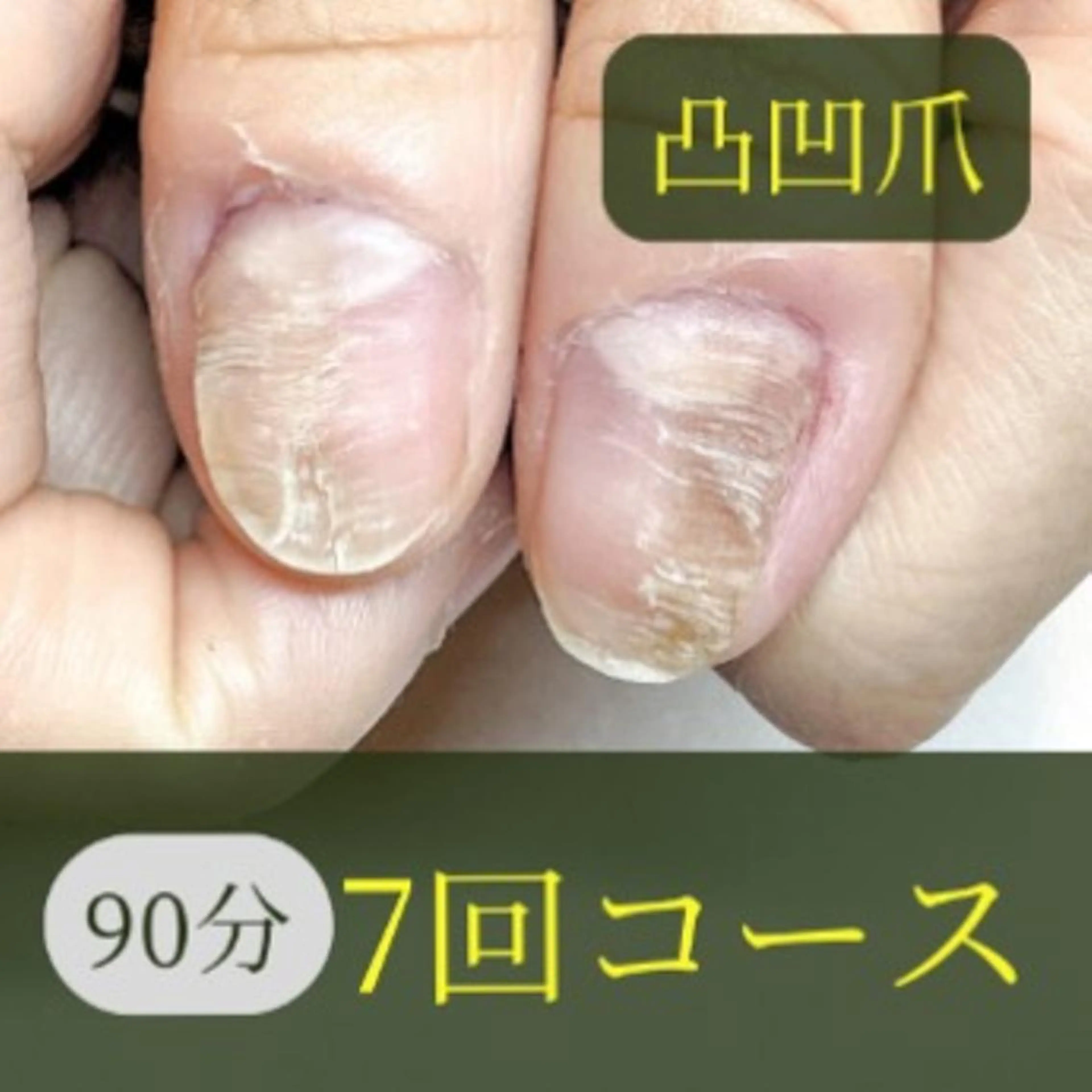7回コース/爪変形-凸凹(90分)の写真