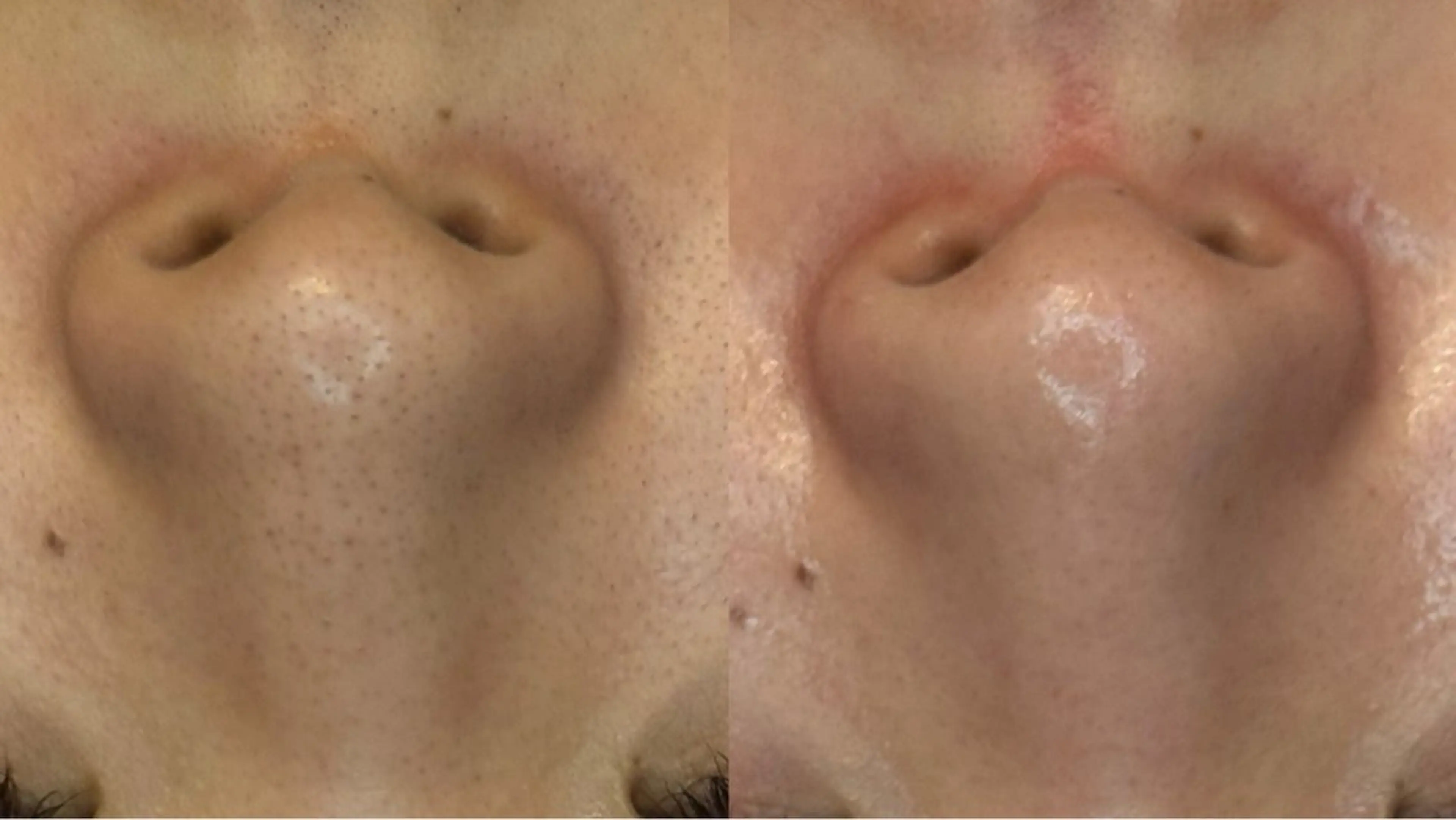 毛穴洗浄、細胞活性化などトータル美肌ケア。メンテナンスにも最適の写真