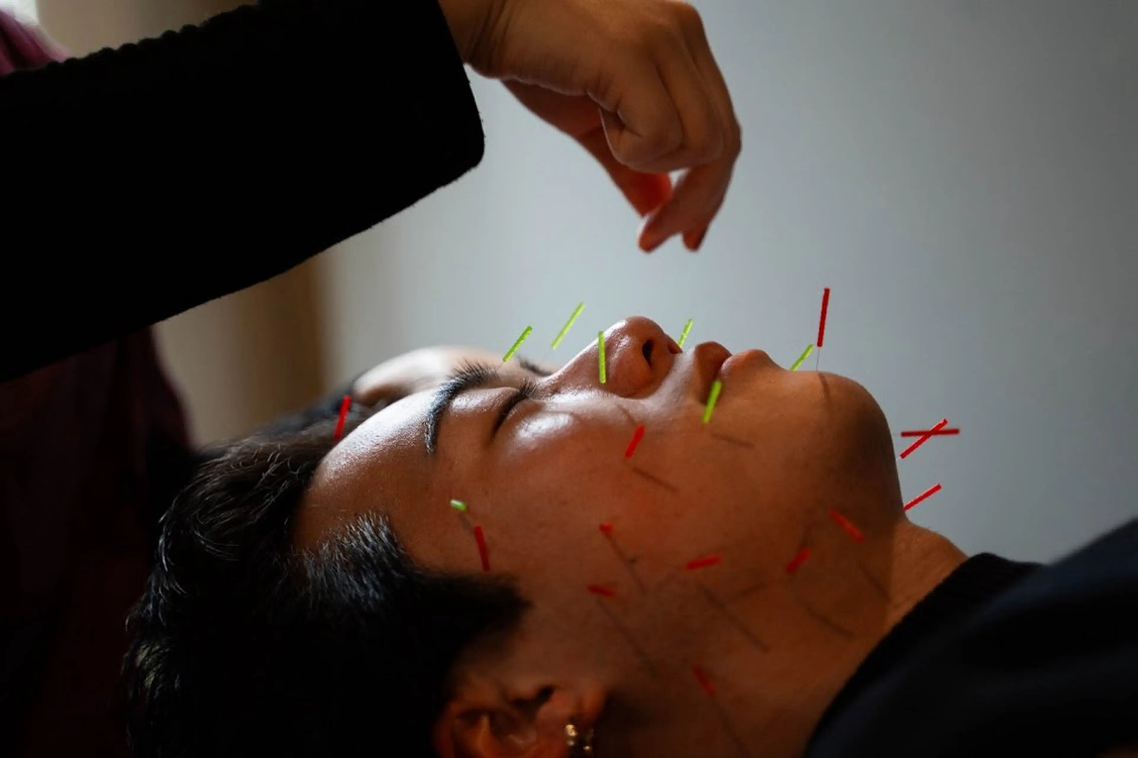 【鍼灸オススメNo.1 】エイジングビューティー美容鍼×美体鍼　70分　¥7980 → ¥6980の写真