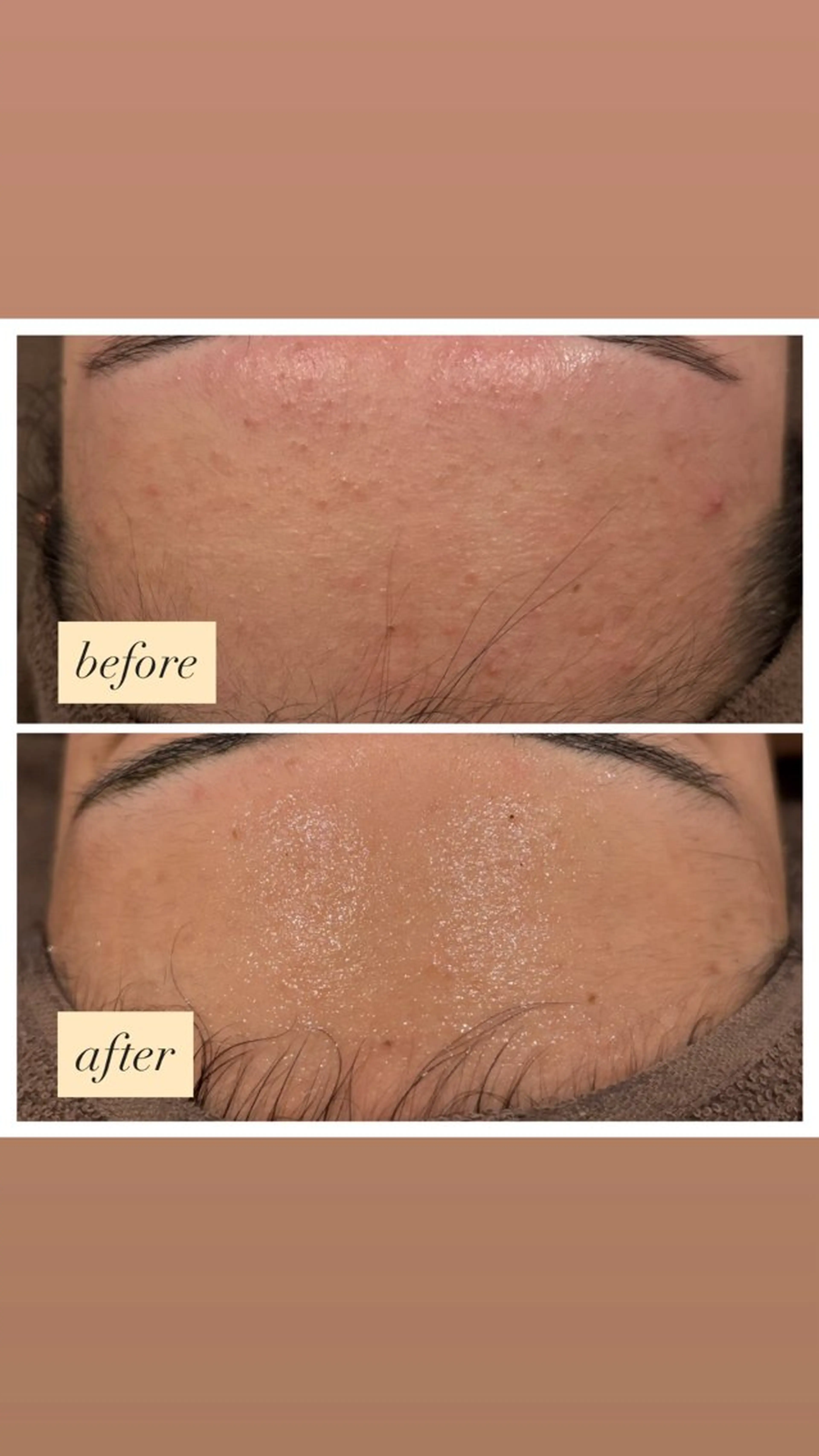 ハーブピーリング‪🍃◎毛穴の開き・黒ずみ  ◎ニキビ・ニキビ跡　◎くすみ・ザラつきの写真