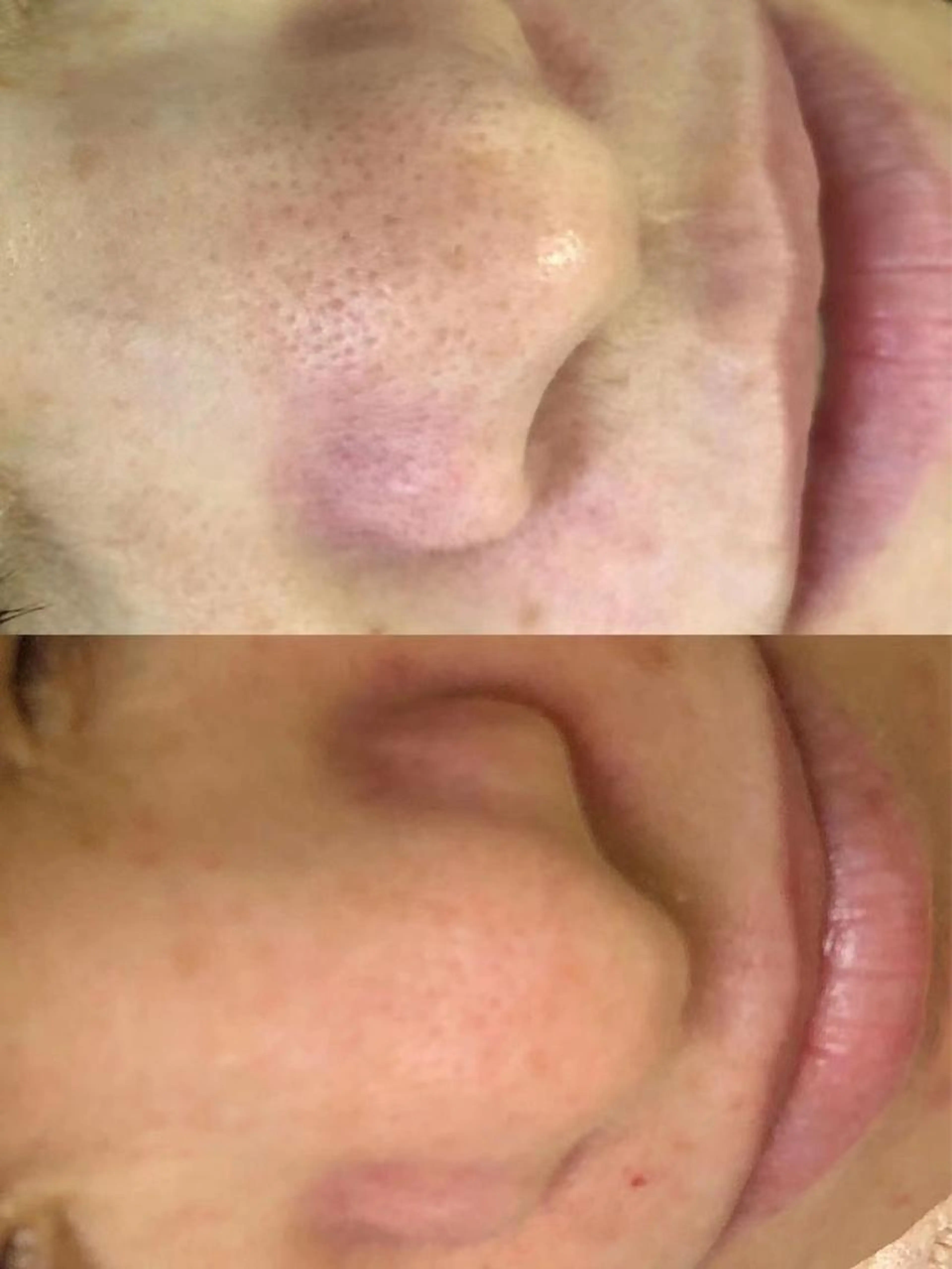 ハイドラトリートメント、いちご鼻改善の写真