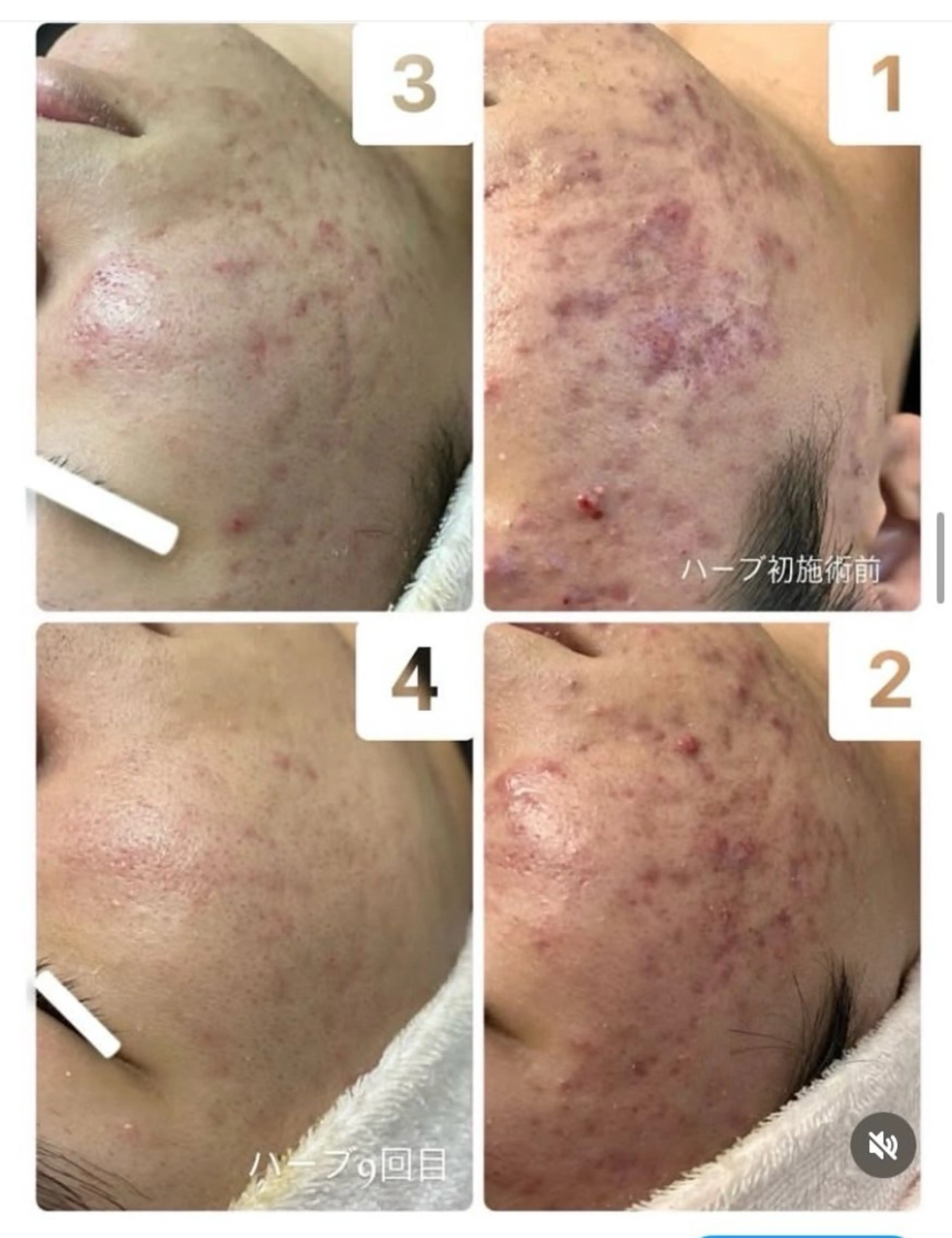 【毛穴・ニキビ跡】剥離なしハーブピーリング 3回分24,000(1回8000)の写真