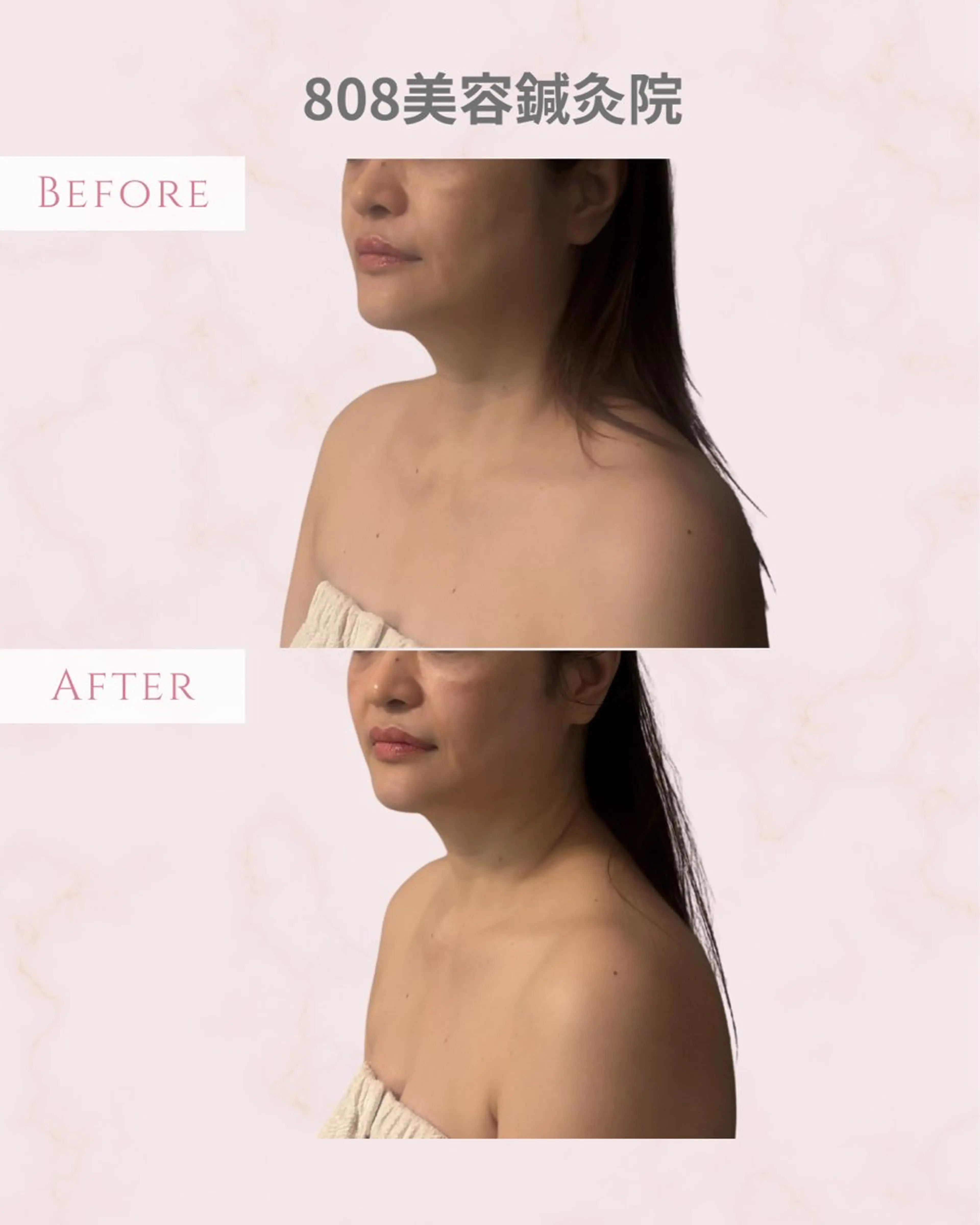 エステ 圧倒的たるみ改善 美容鍼エステのエステ・リラクイメージ