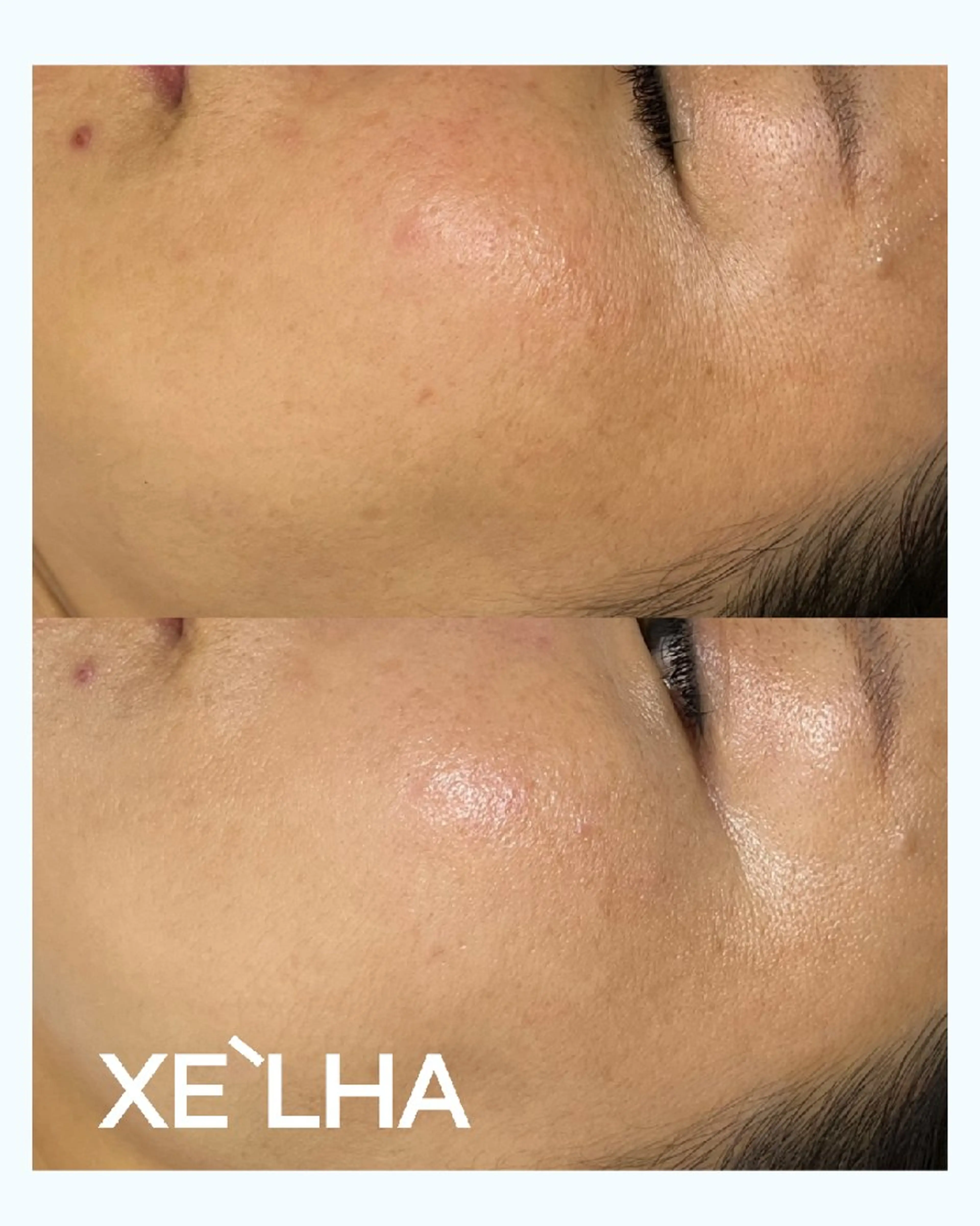 ミニモ限定💎 セラピール（2025年ピーリング部門韓国No.1｜剥離なしで毛穴・くすみ・ニキビに効果的次世代ピーリングの写真