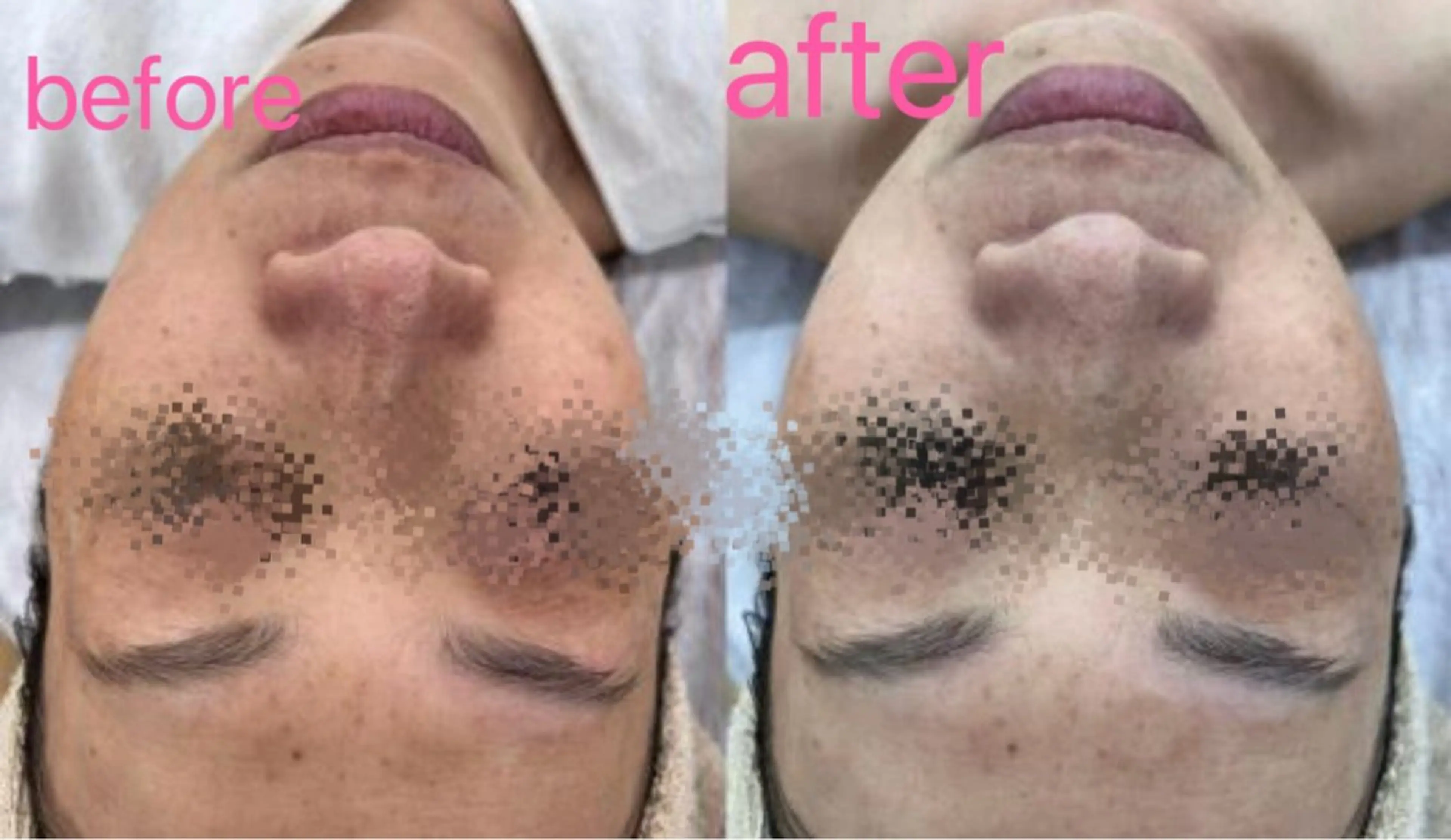 【人気No.２】一回で絶対美白★毛穴洗浄付き白玉肌コース￥12,660→新規¥10,560の写真