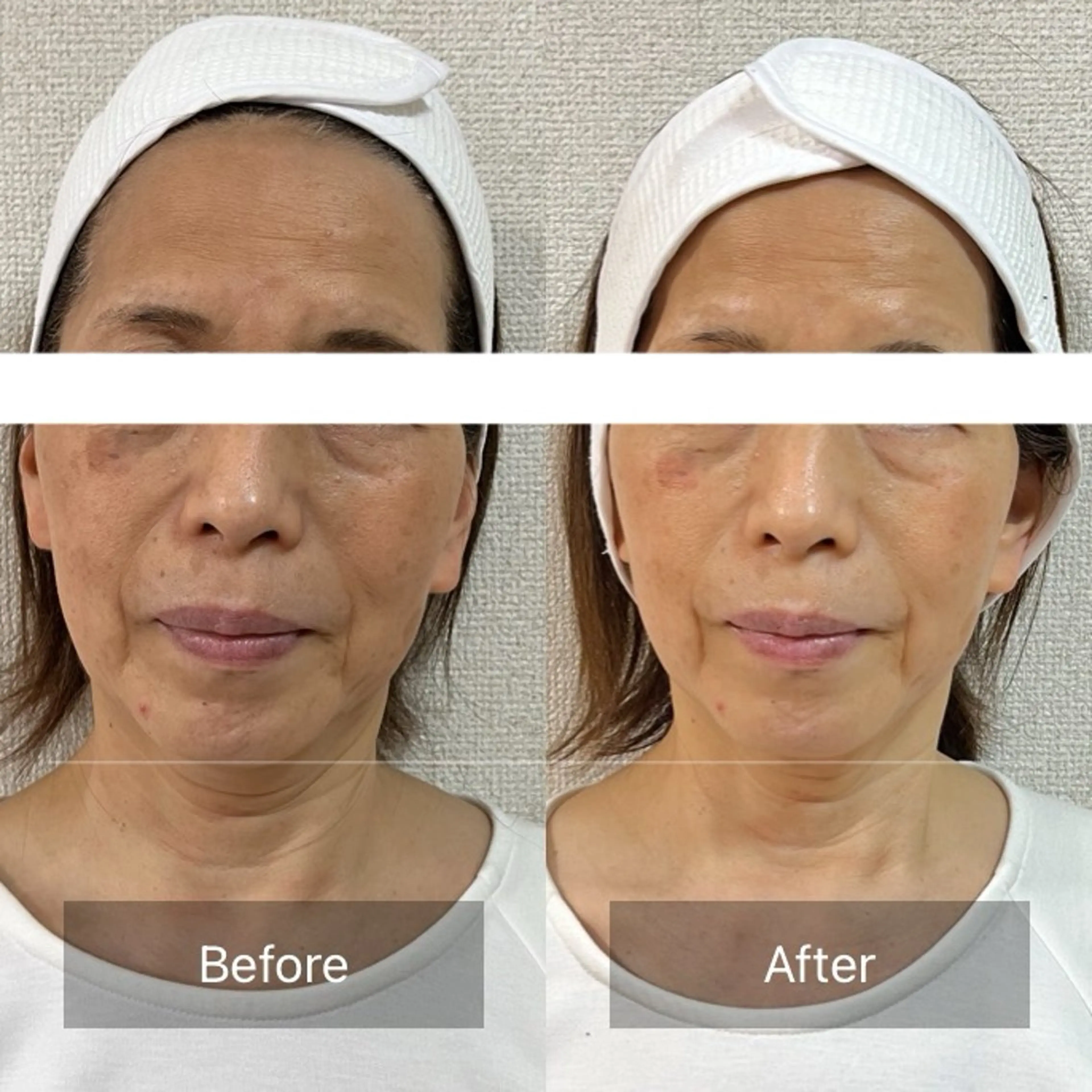 小顔×肌質改善 《お顔の印象》のエステ・リラクイメージ