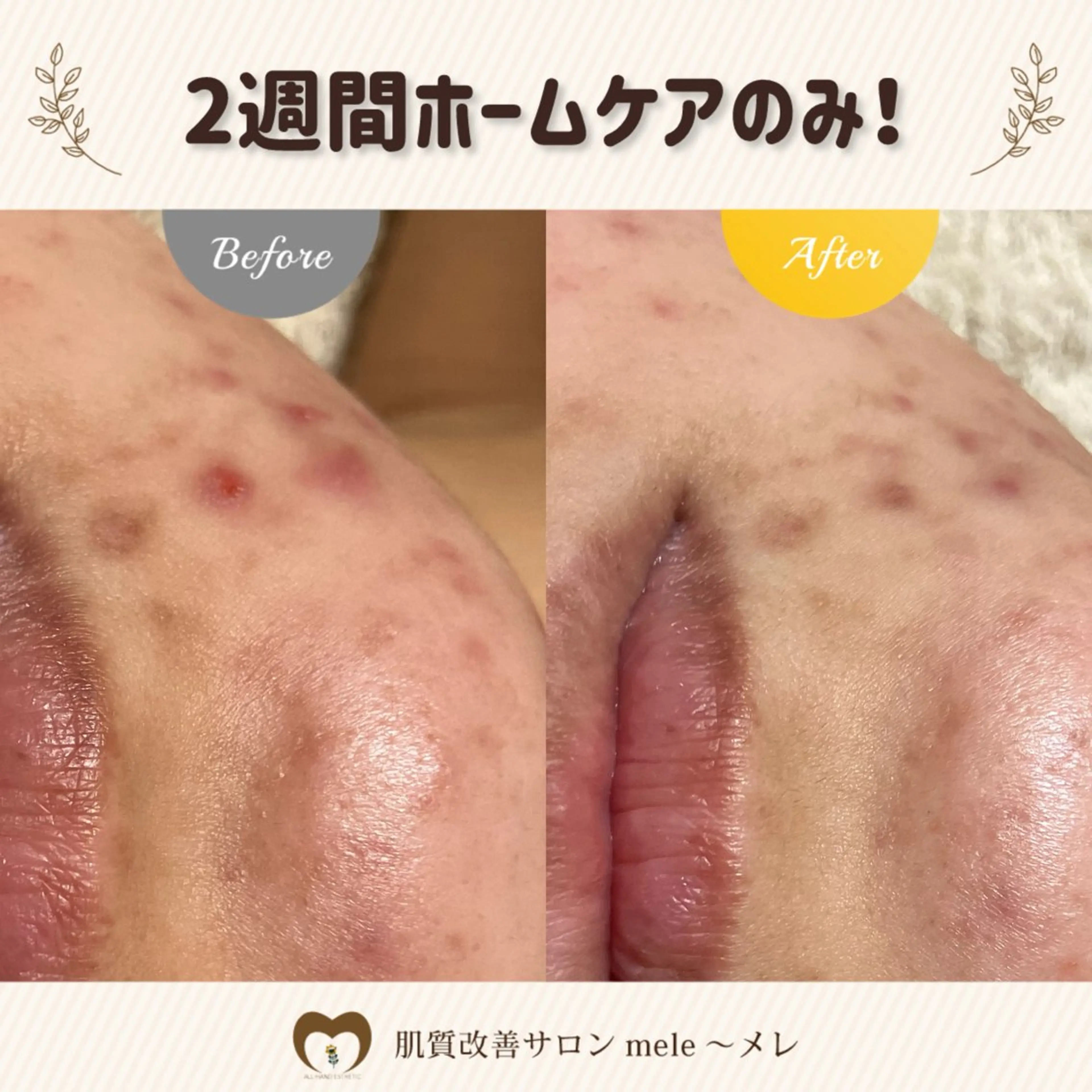 繰り返すニキビ・毛穴 ✨つくば肌質改善専門のエステ・リラクイメージ