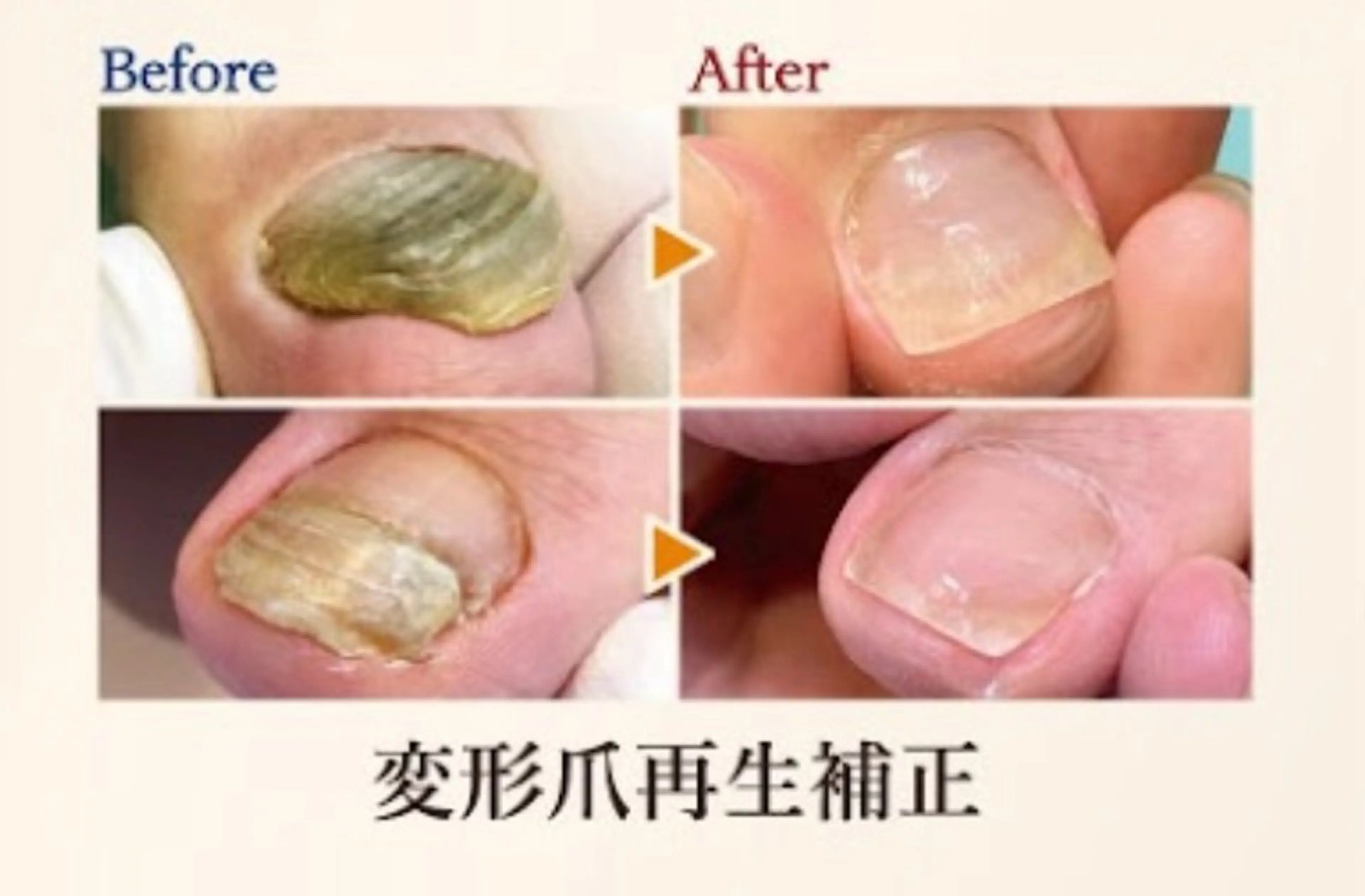 【足の分厚い爪、深爪再生補正】思わず隠したくなるその爪、、😰諦めないで下さい✨正常な爪へ再生致します🔅の写真