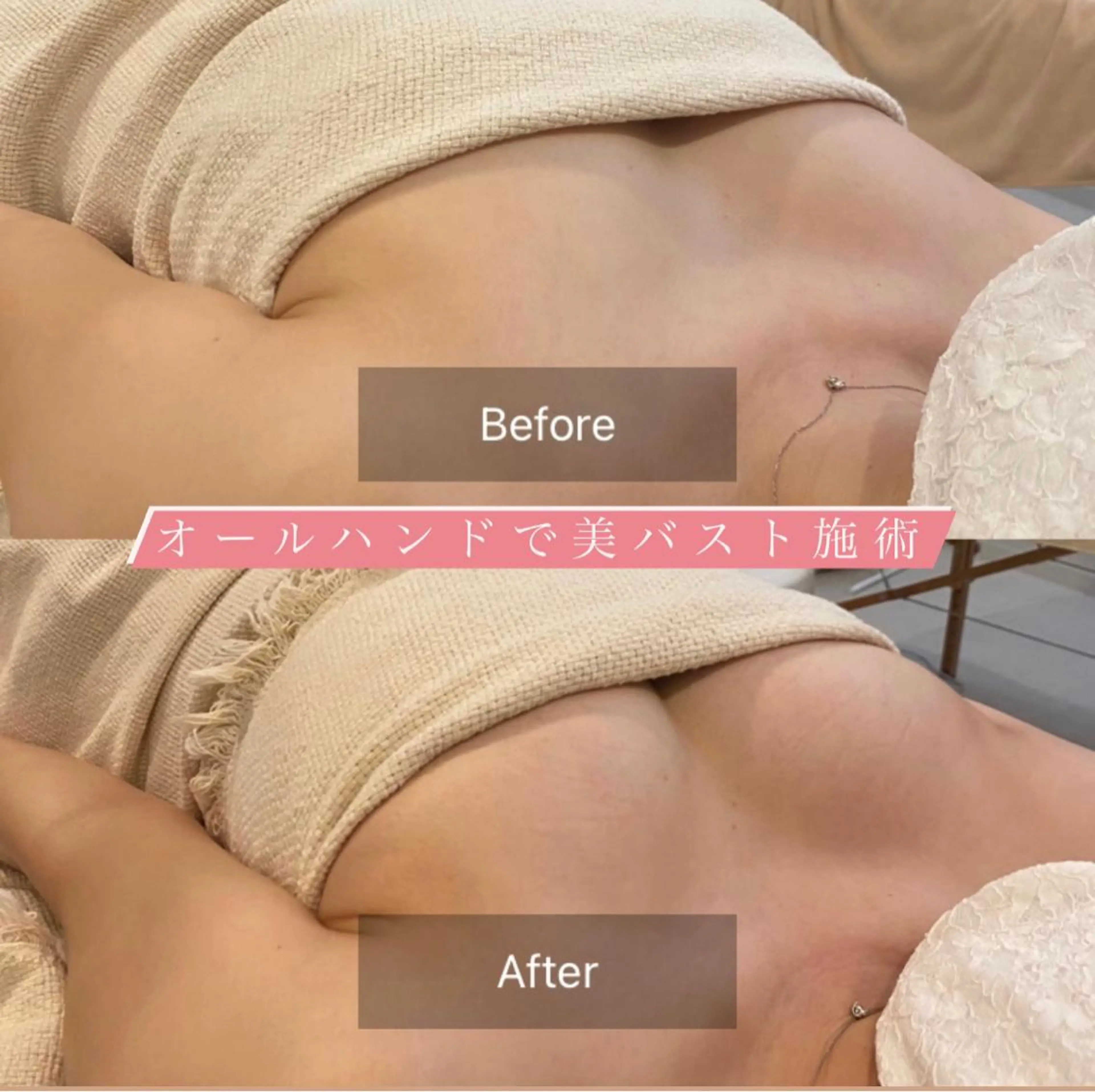 美バスト豊胸施術の写真