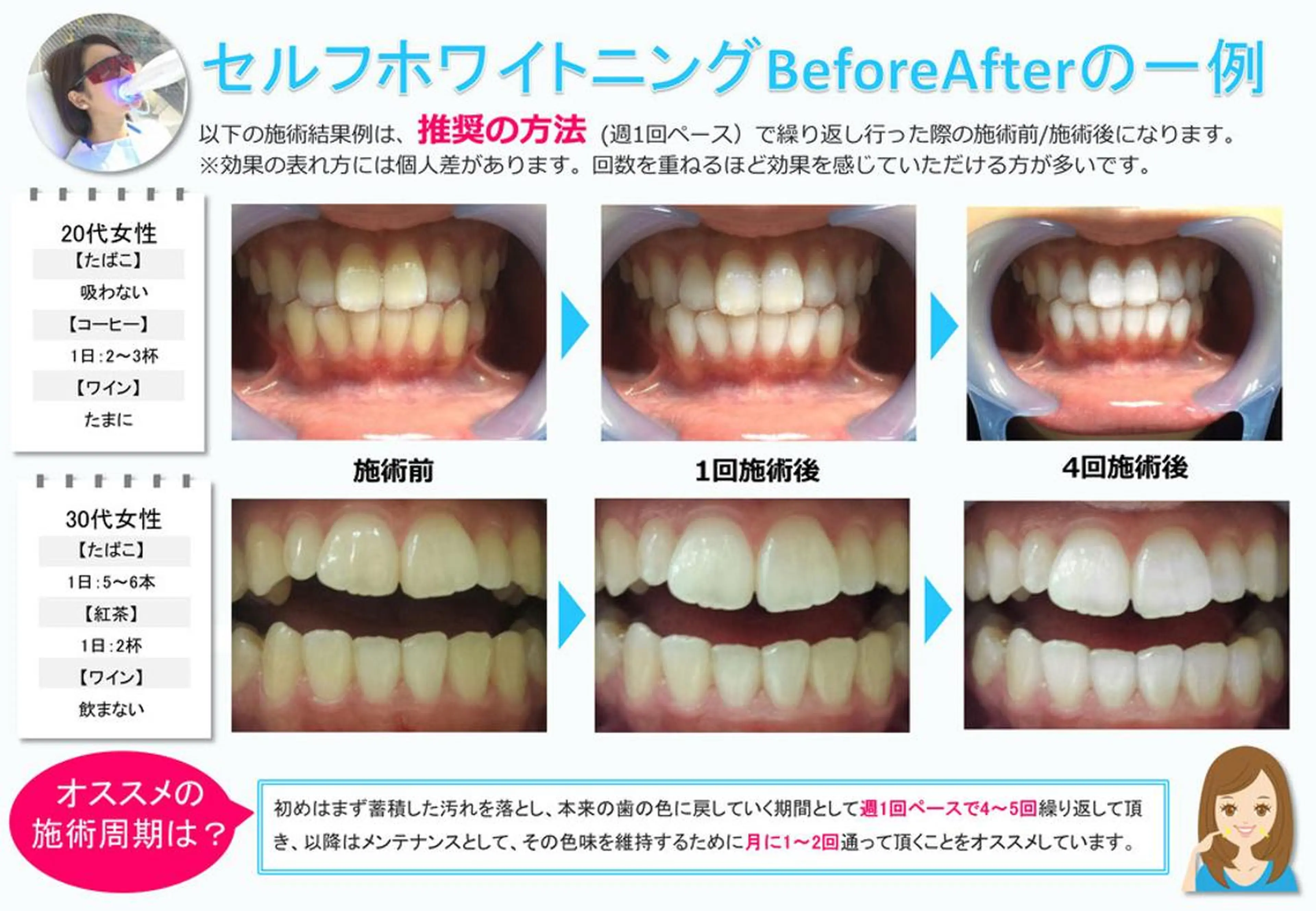 歯のセルフホワイトニング　ホワイトニング最新機種導入の写真