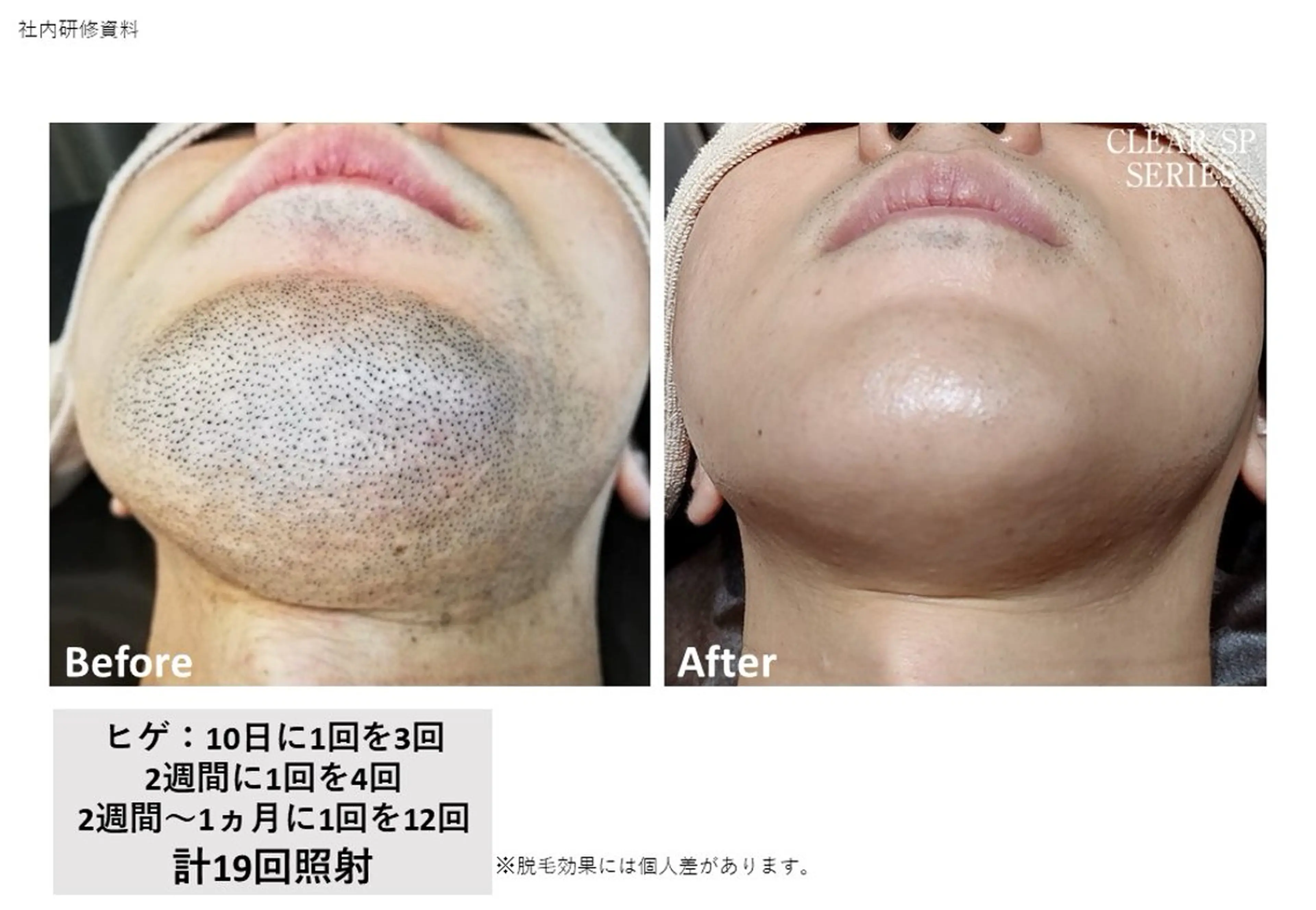 男性🫧お顔脱毛チクチクとは無縁に!!の写真