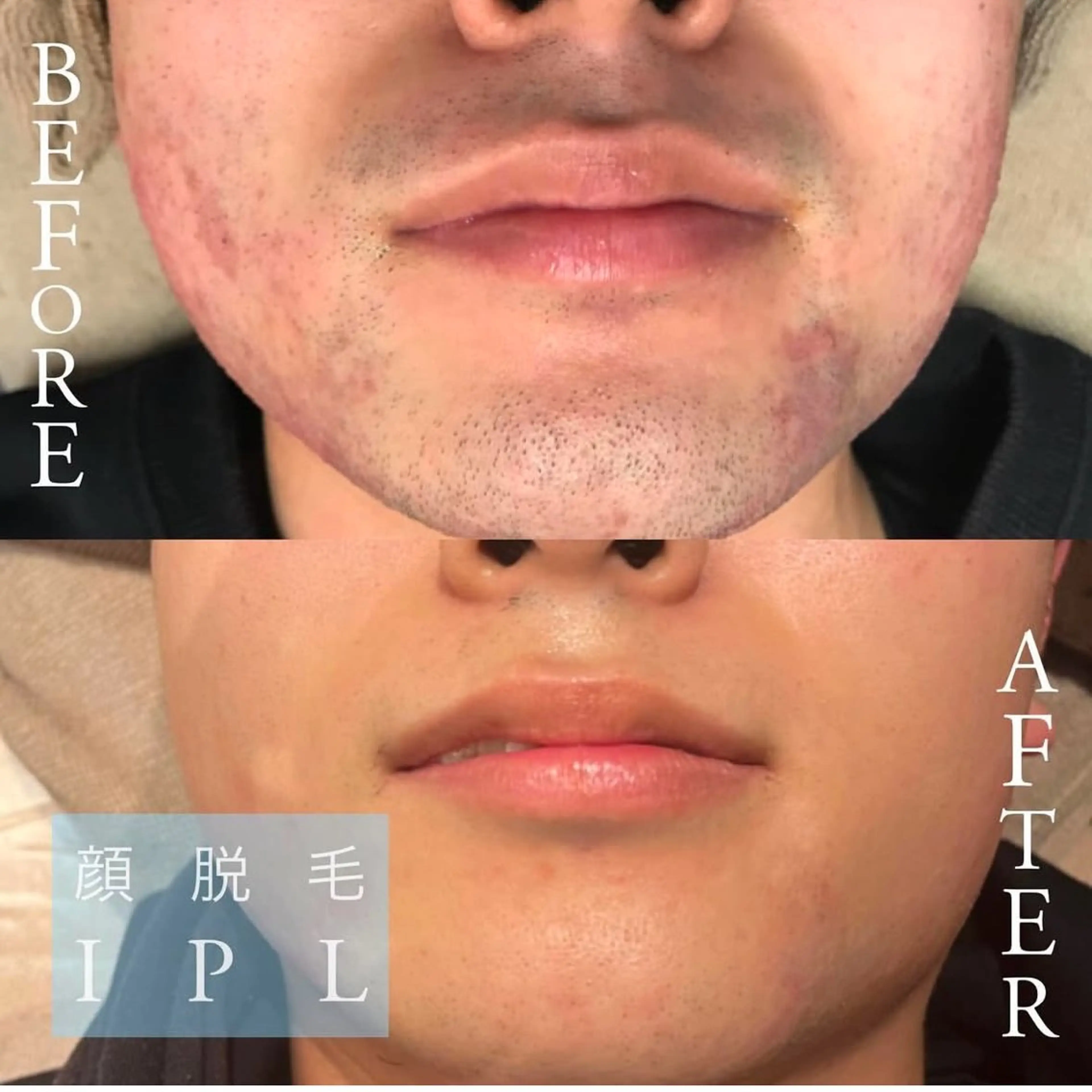 脱毛 Lilyboo 池袋のエステ・リラクイメージ