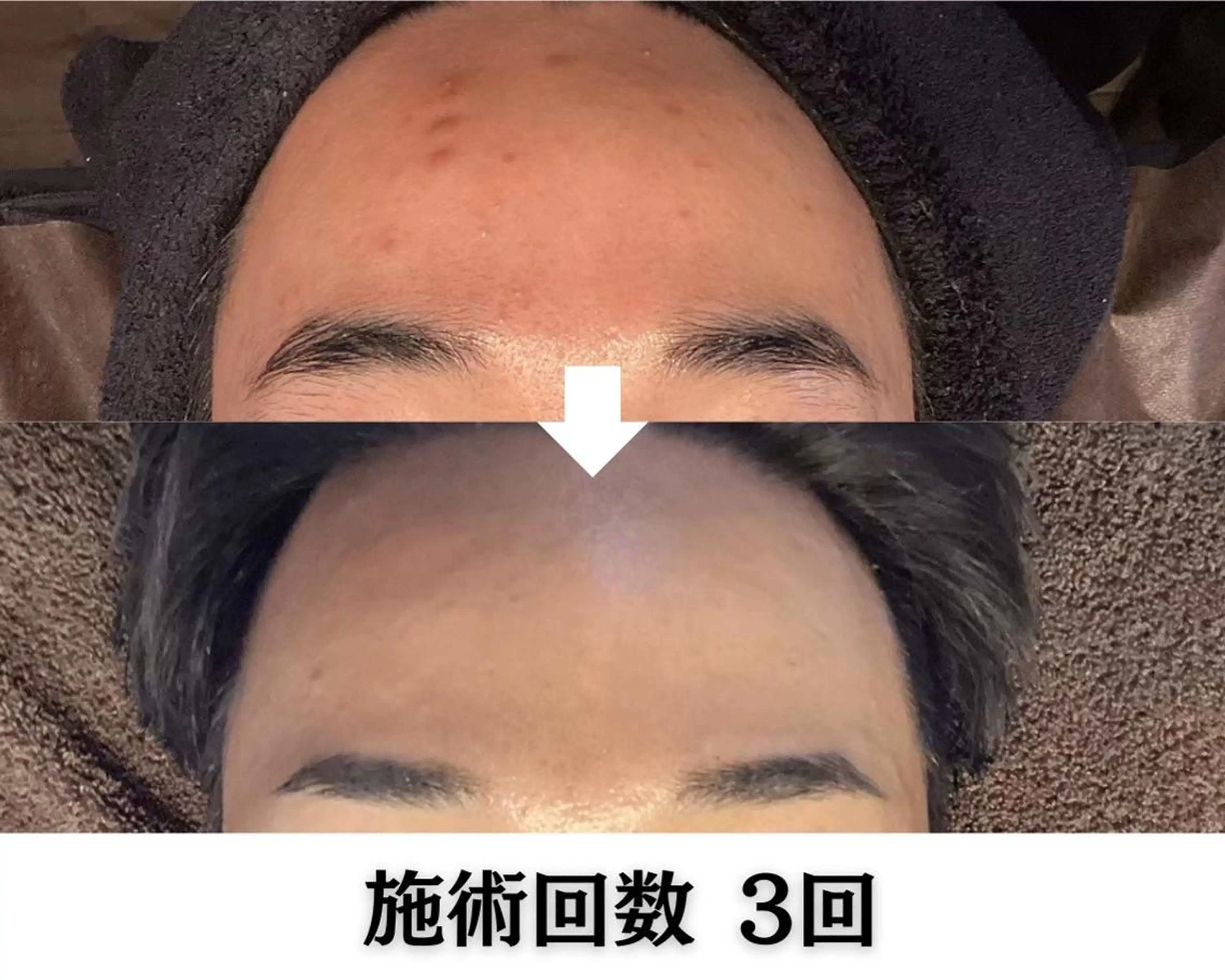 池袋ニキビ毛穴改善 🌿ハーブピーリングのエステ・リラクイメージ