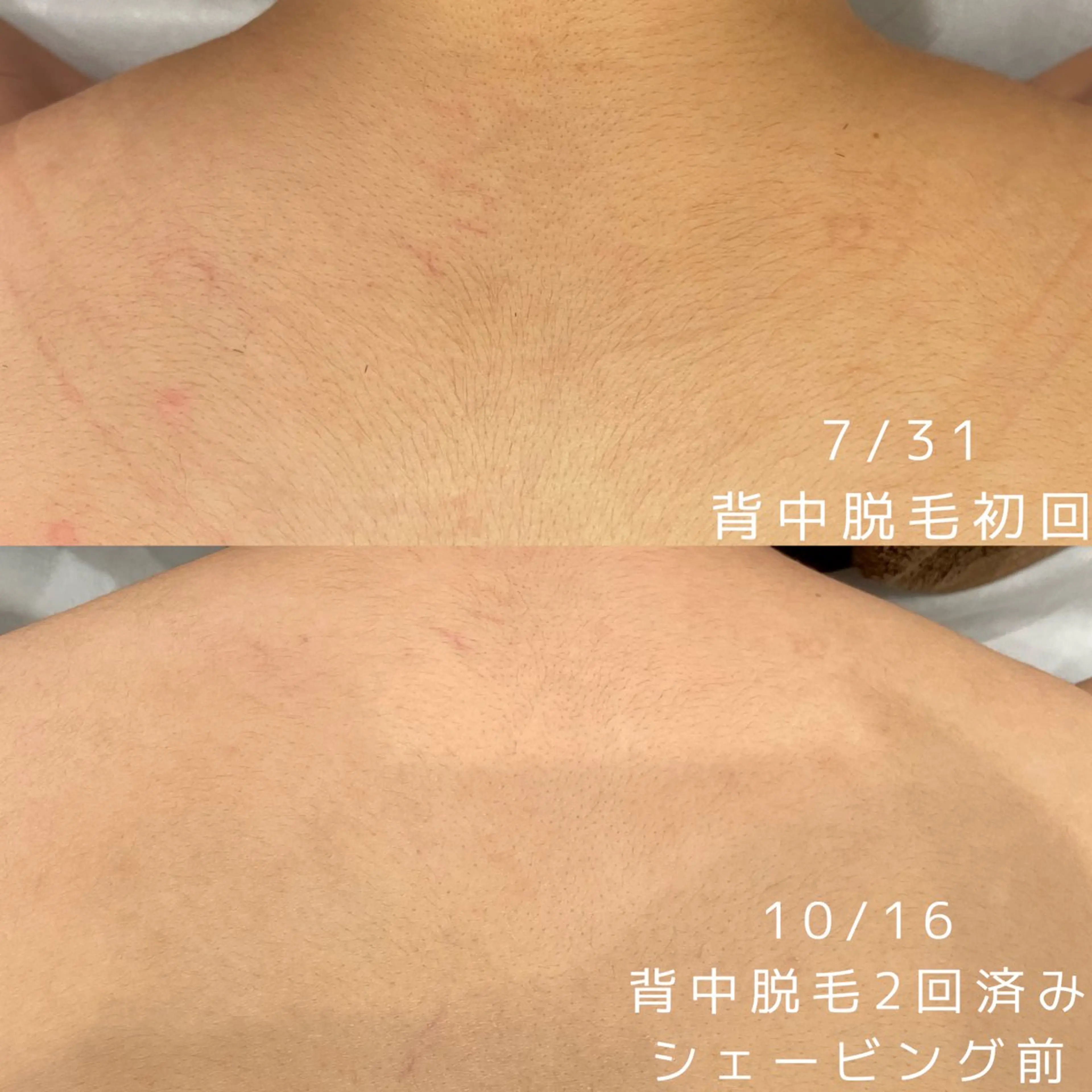 【脱毛】《ヒジ上下、ヒップ、ヒザ上、ヒザ下、背上、背下》　各¥2,200⭐️の写真