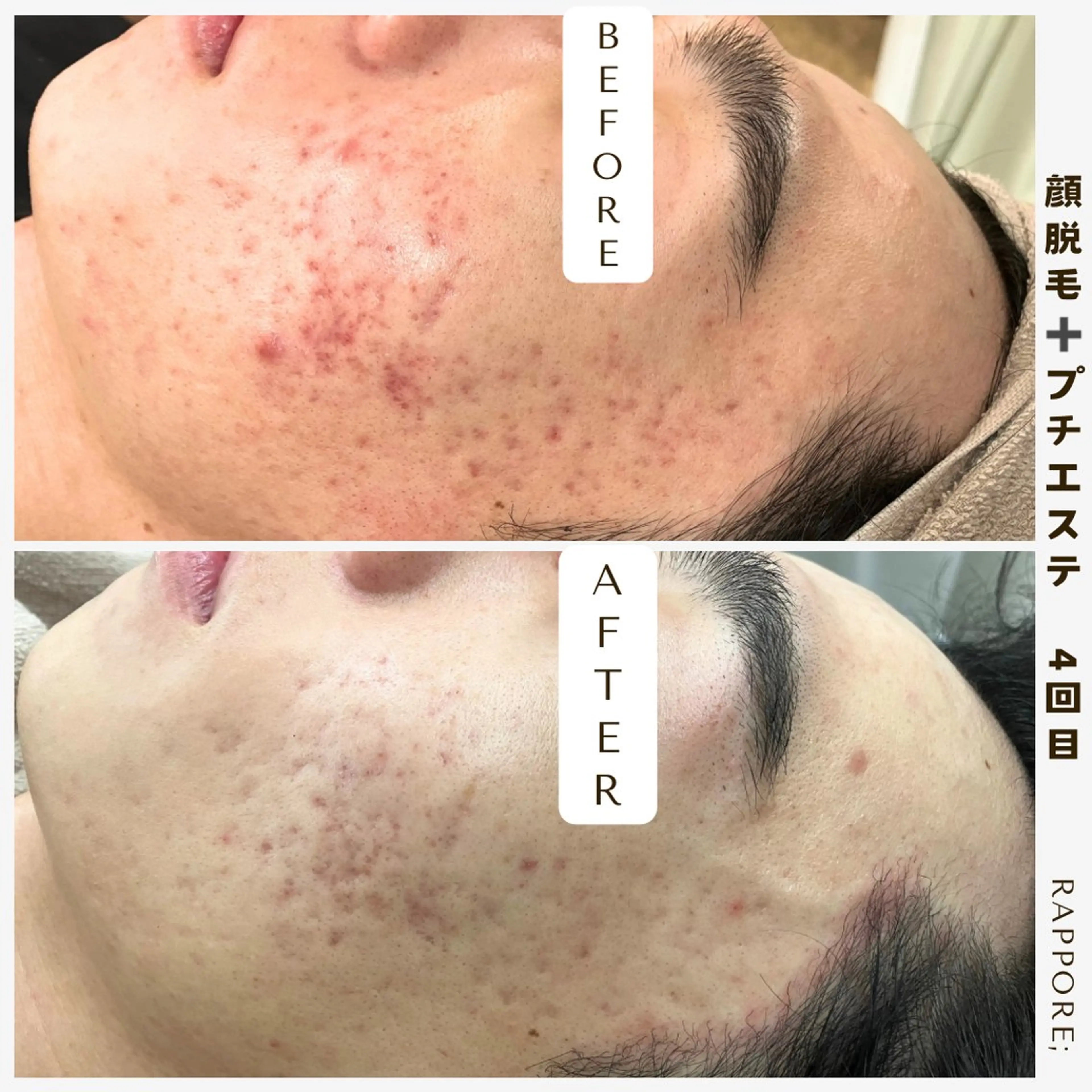 【毛穴汚れ撃退✨】メンズ♡顔脱毛+プチエステ付きの写真