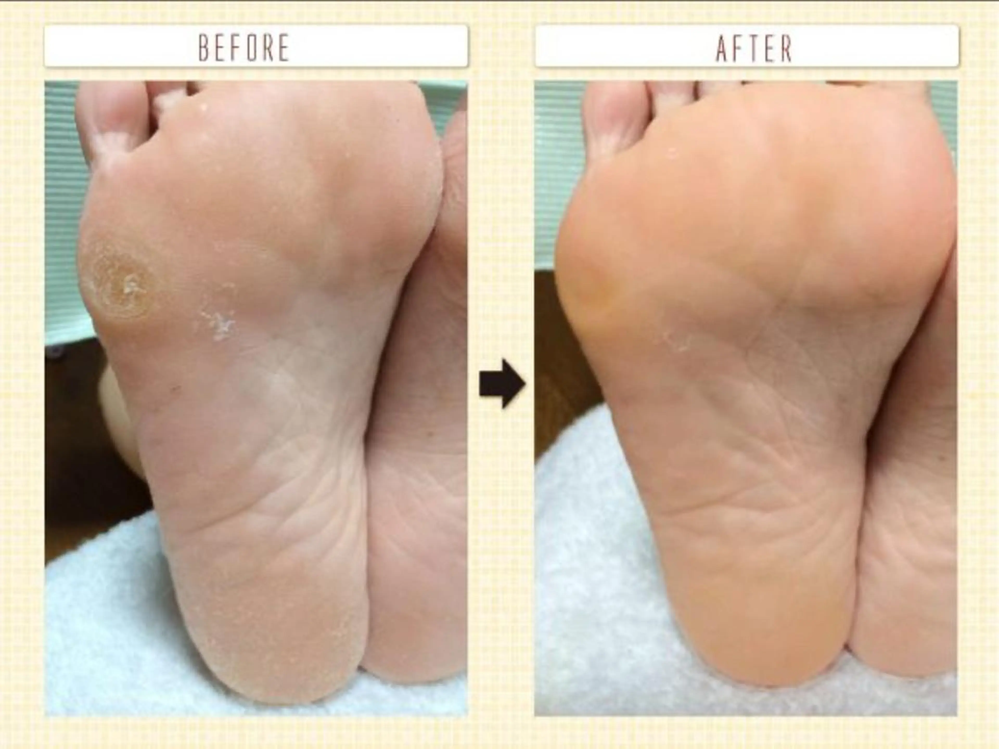 フスフレーゲ(フットケア)フットバス・爪カット・爪磨き・古い角質除去・タコ、痛い魚の目除去・マッサージ・保湿の写真