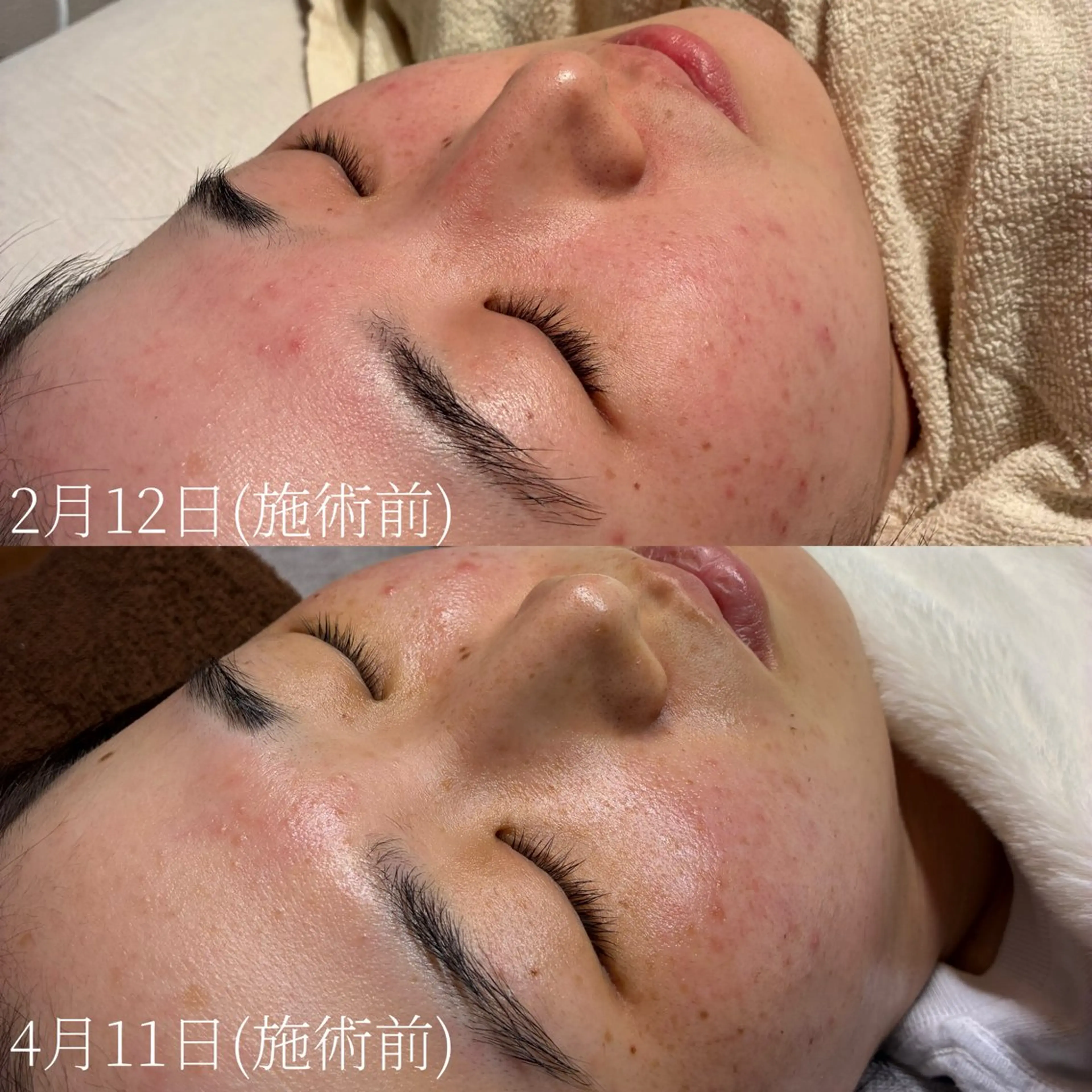 【人気No.1】フェイス＋うなじワックス脱毛｜マッサージ＋鎮静付✨透明感＆垢抜け肌への写真