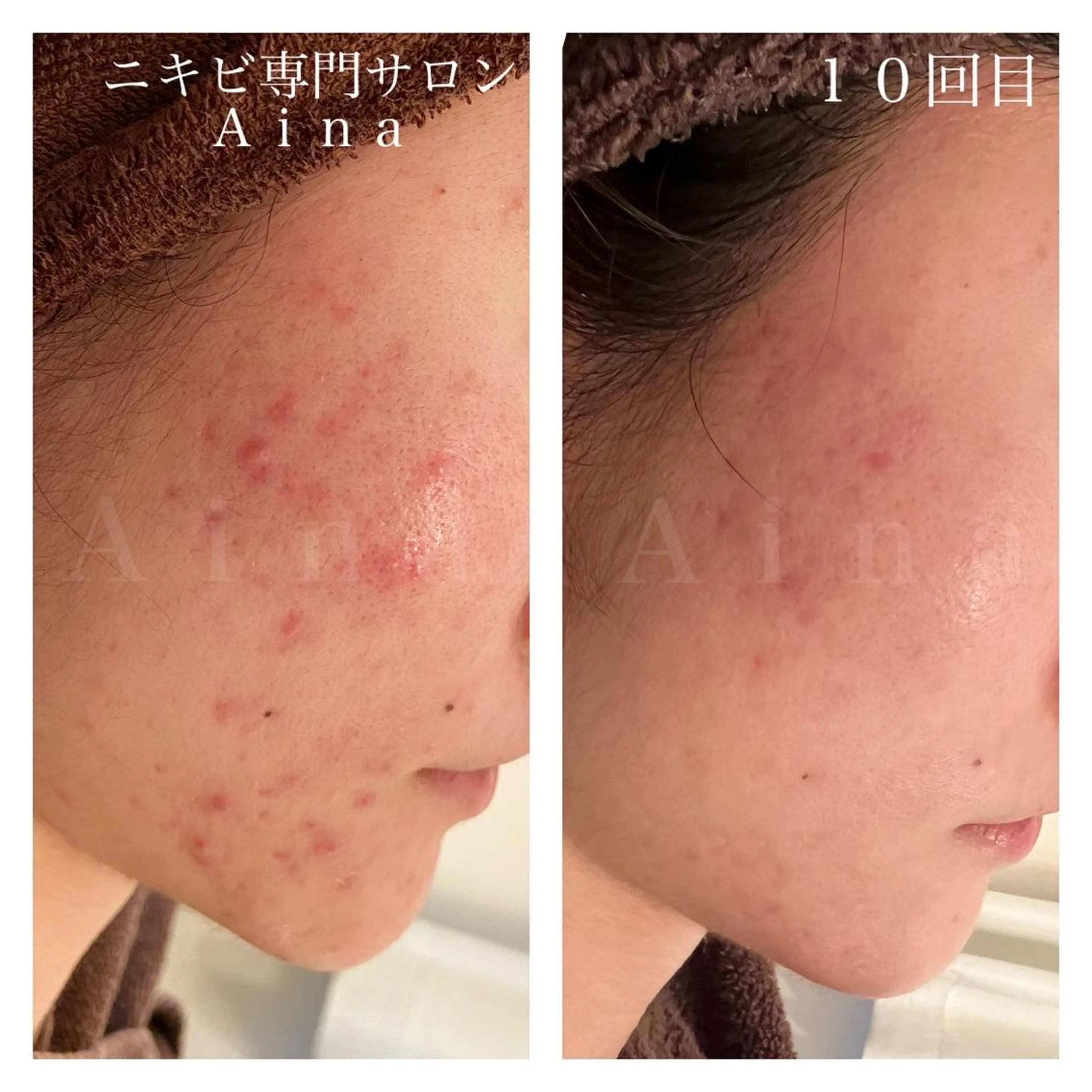 セミロング パーマ ヘアアレンジ メンズ キッズ ネイル マツエク・マツパ 赤色 ニキビ跡専門サロン Ainaのエステ・リラクイメージ