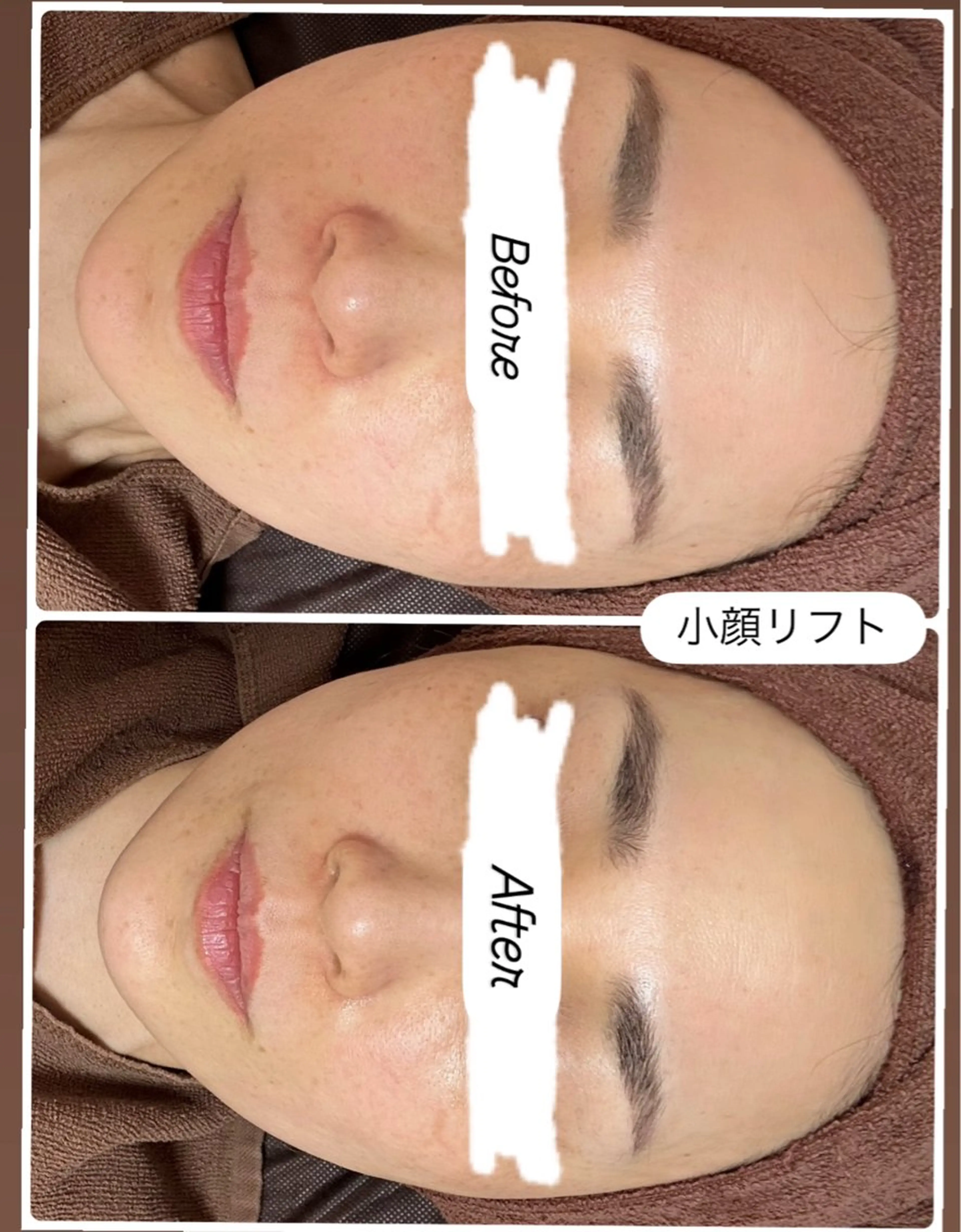 小顔リフトアップ✨シンプルコースの写真