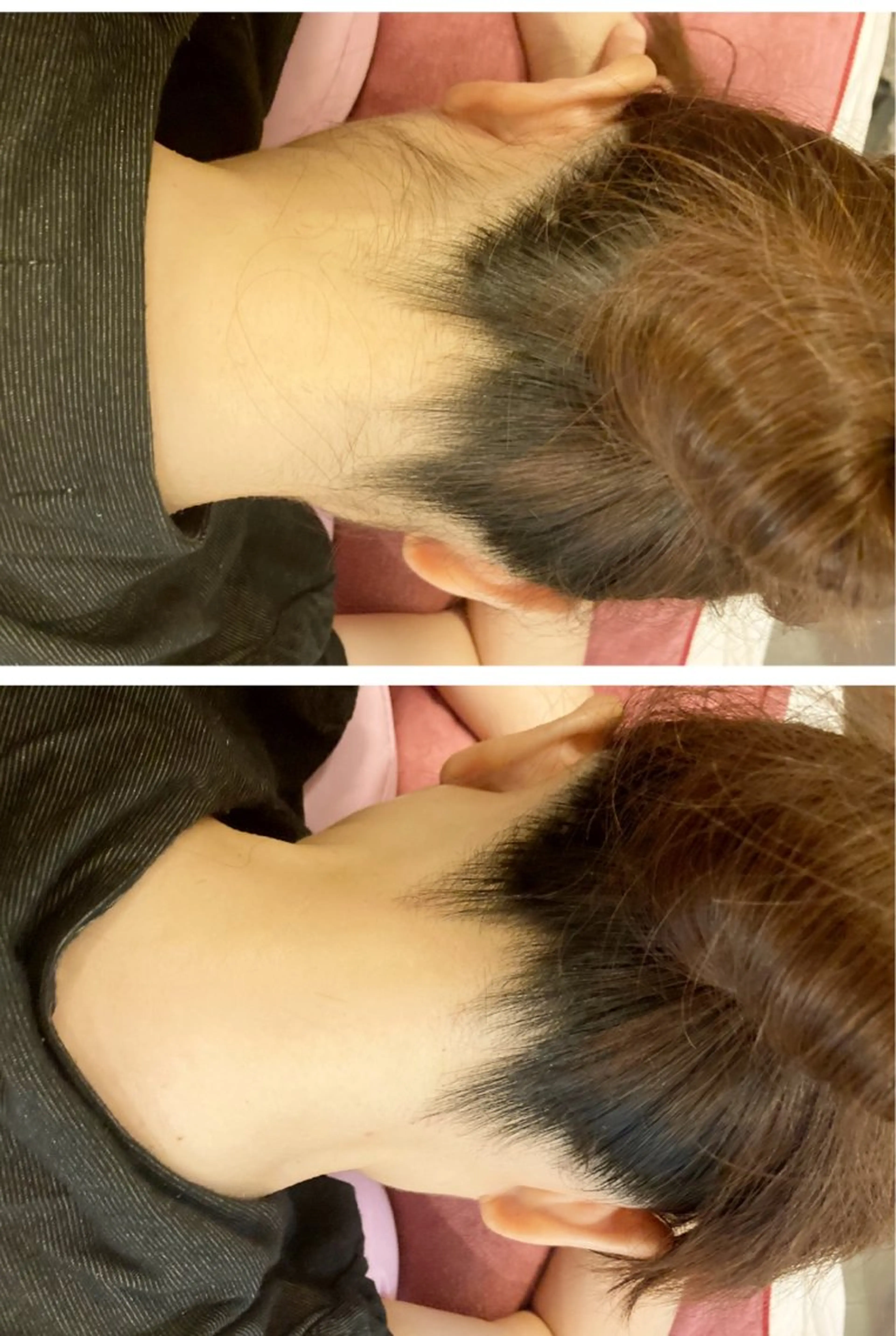 【うなじ脱毛お試し】清潔感アップ✨後ろ姿に自信が持てるうなじ脱毛の写真