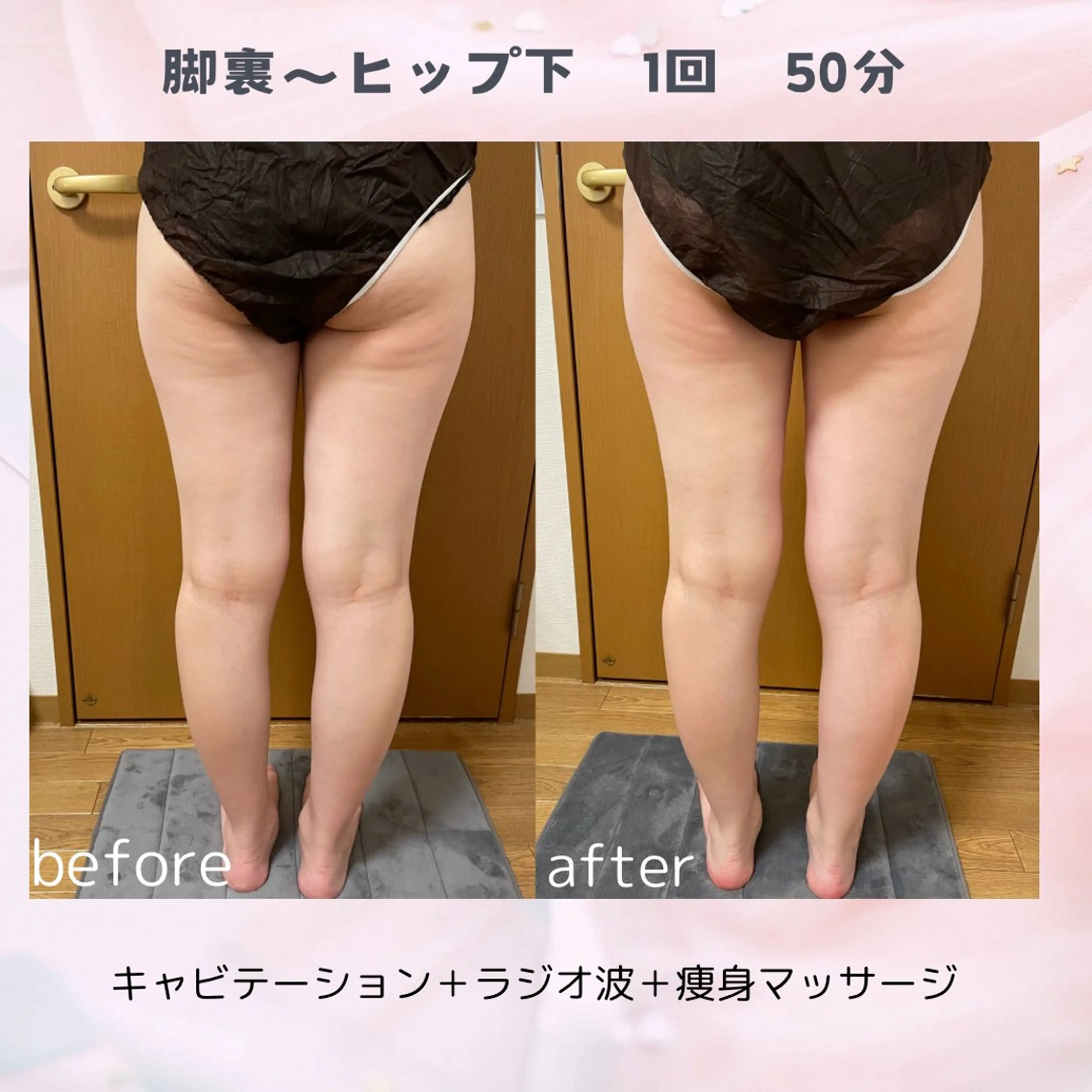 《痩身都度払い》脚裏引き締め美脚美尻コースの写真