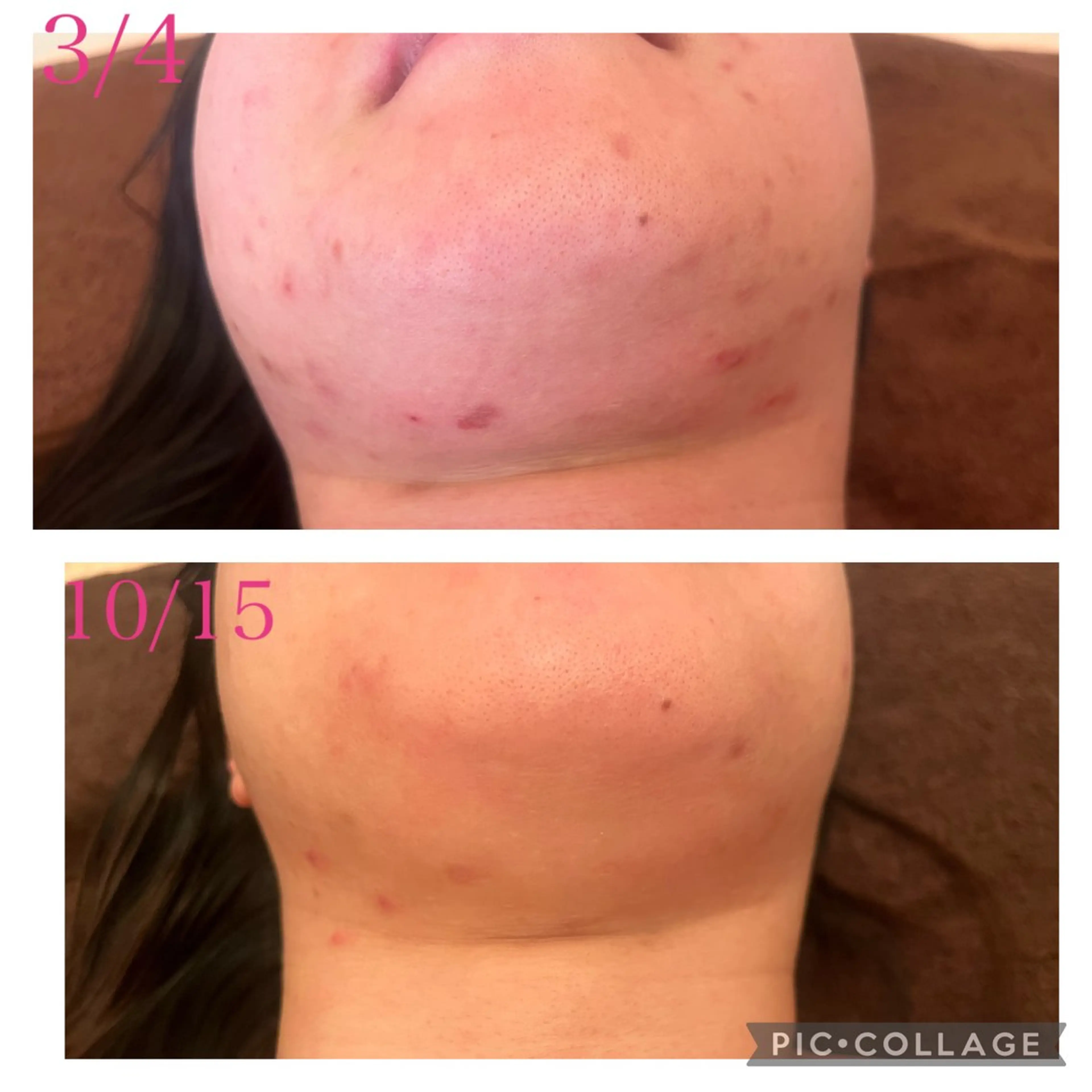 3/25迄ハーブ ピーリングBloomのエステ・リラクイメージ