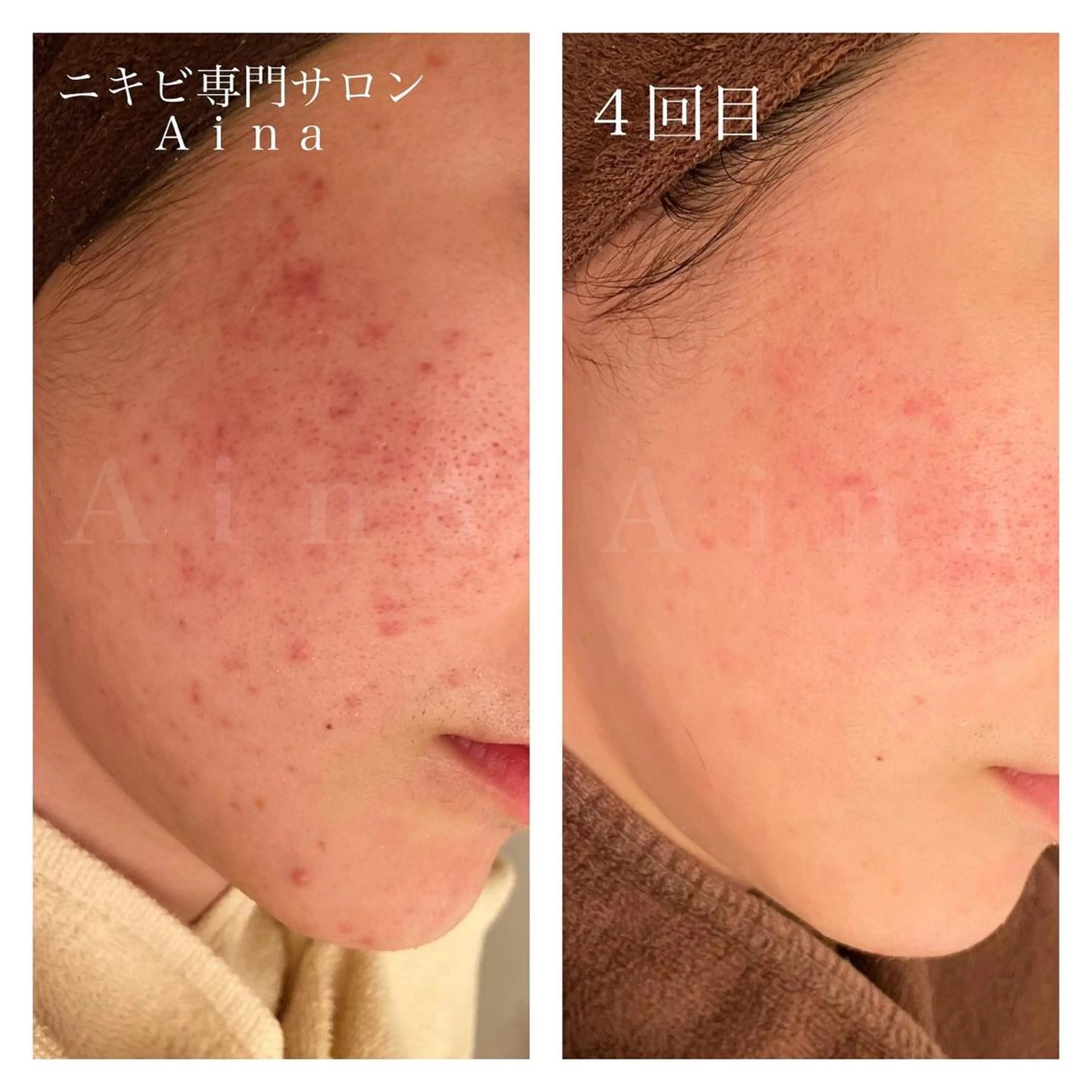 ロング カラー パーマ ヘアアレンジ メンズ キッズ マツエク・マツパ 透明感カラー エステ リラク ニキビ跡専門サロン Ainaのエステ・リラクイメージ