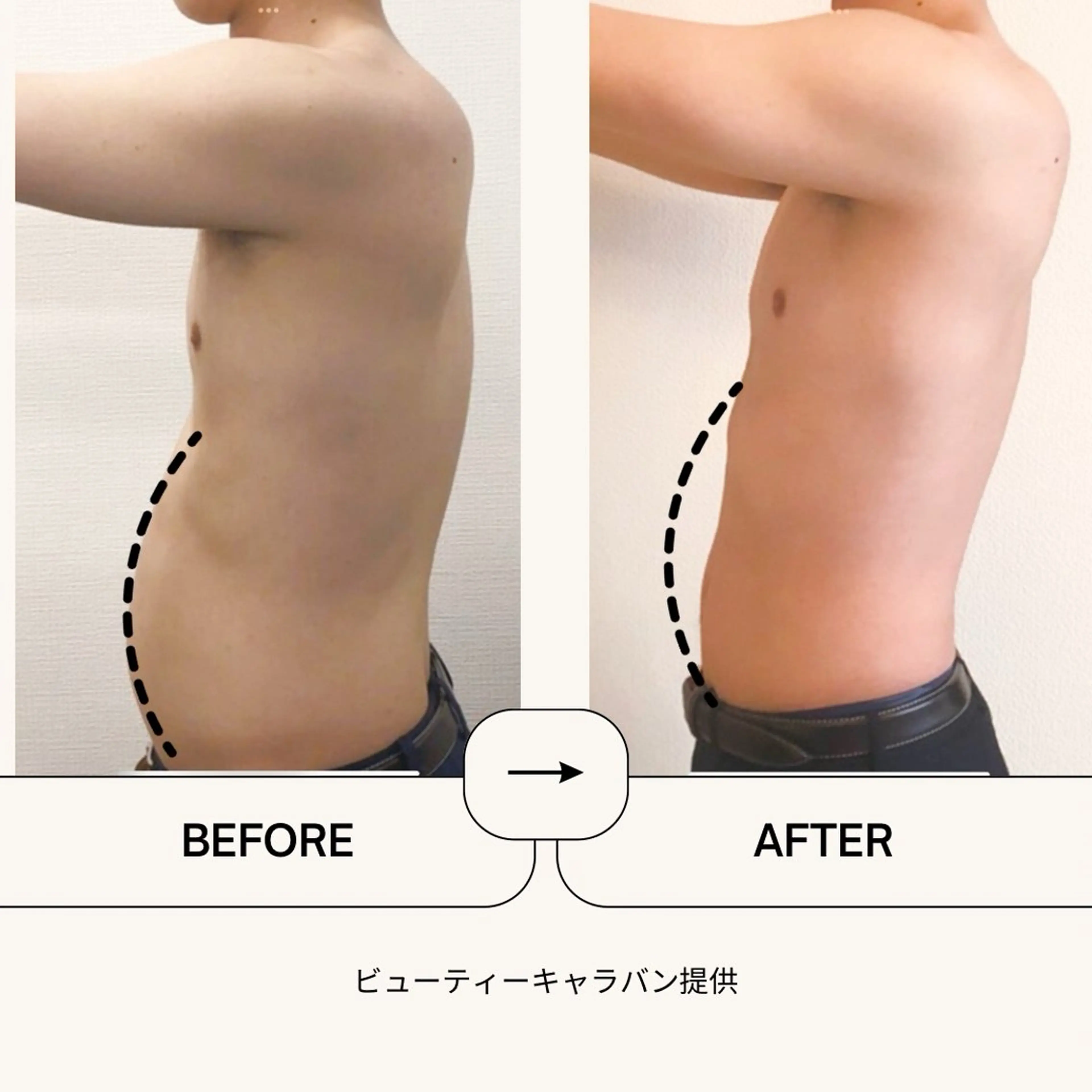 【初回限定35%OFF】 ラジオ波骨盤矯正🤰腰痛/ぽっこりお腹/そり腰/引き締め【骨盤/股関節/腹部/太もも】の写真