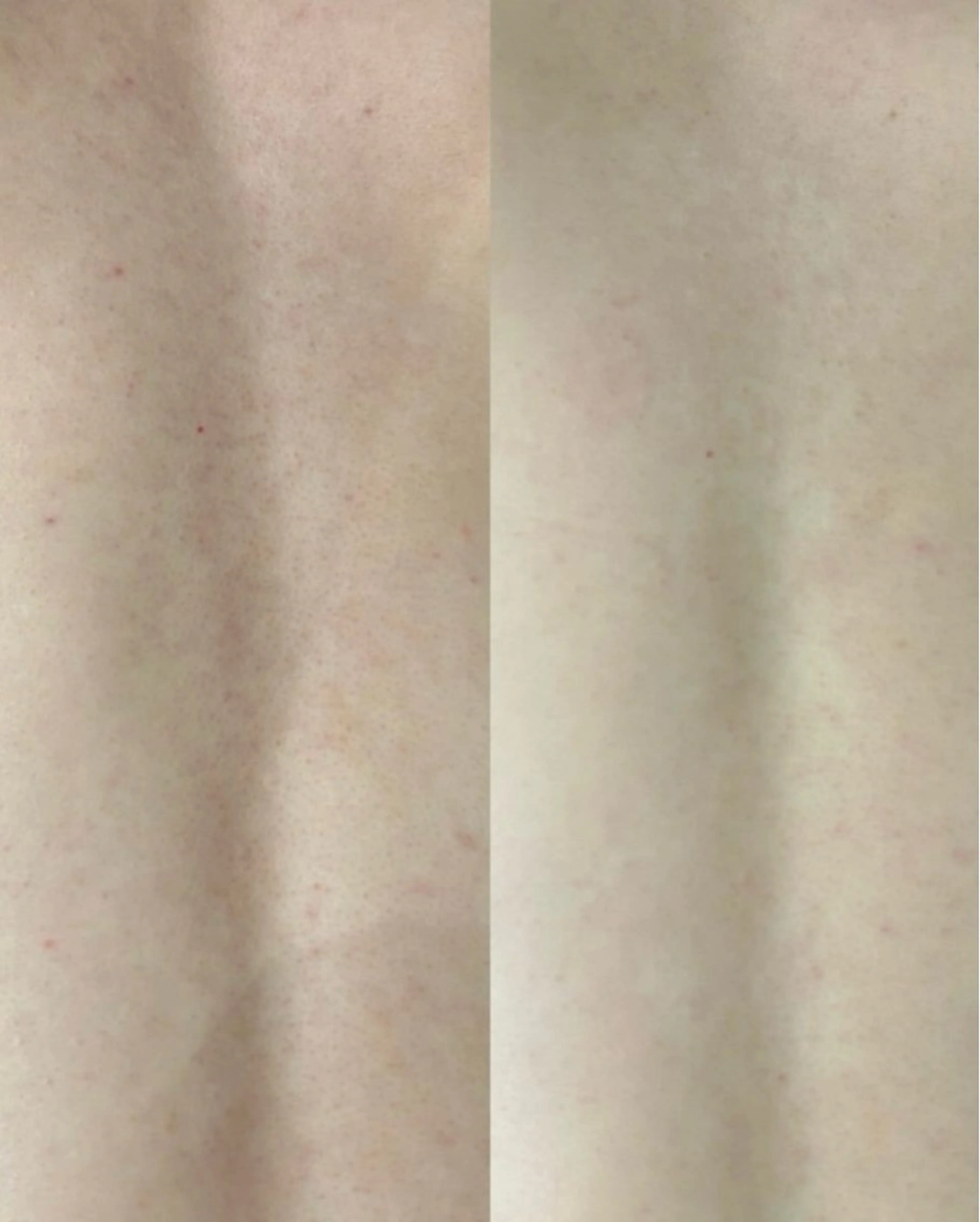 ニキビ・ニキビ跡🌿 ハーブピーリング✨のその他イメージ