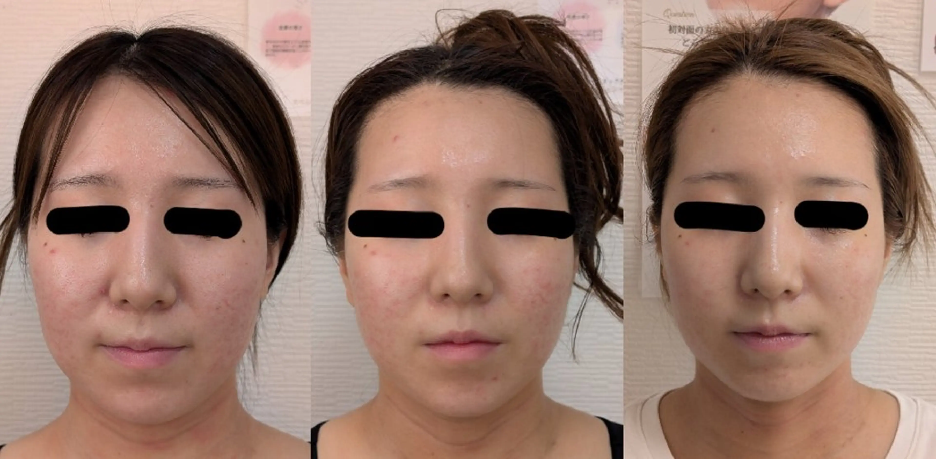 エステ 〈ニキビケアサロン〉 レゾン京橋店/ 浅川のエステ・リラクイメージ