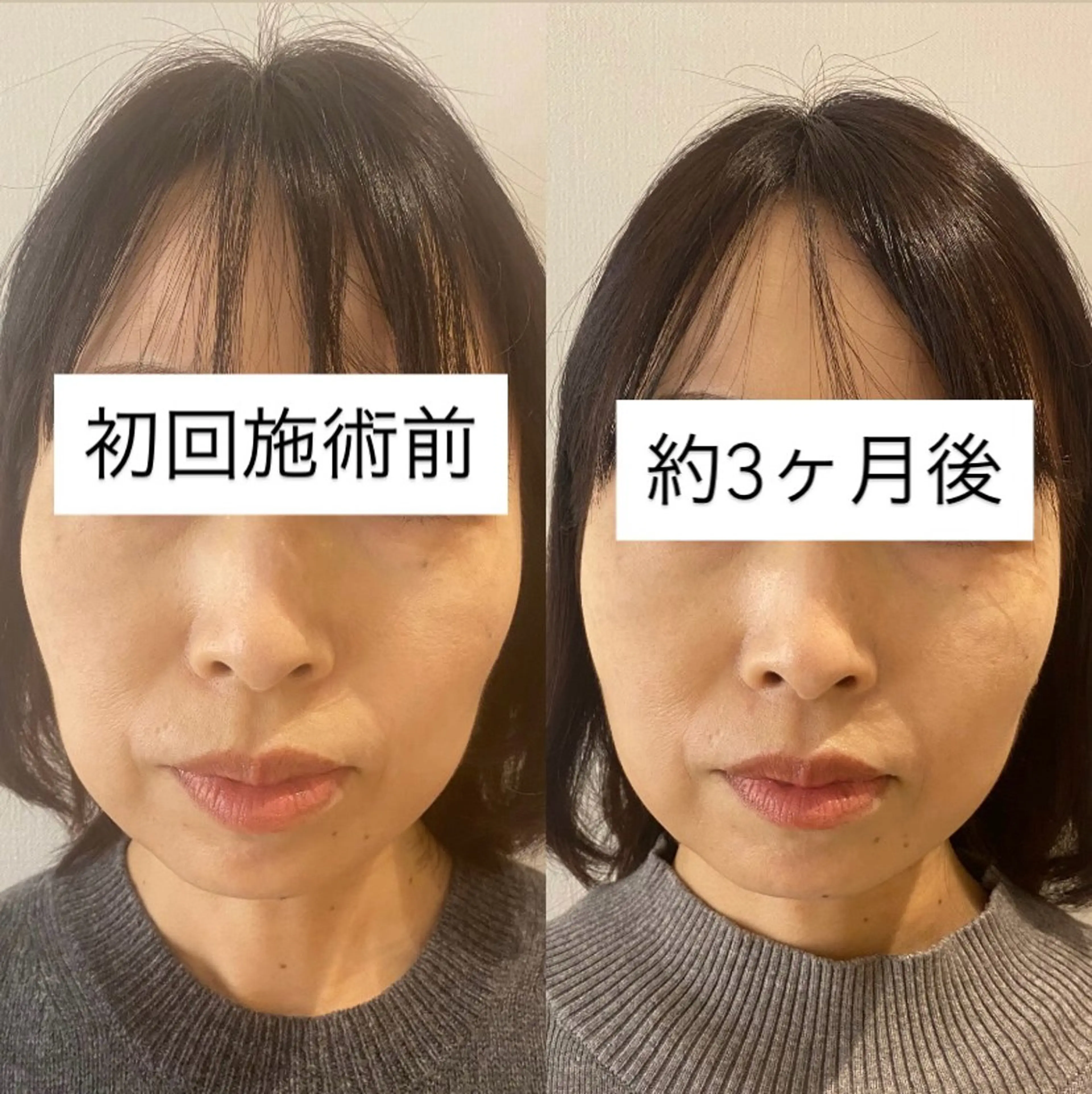 眼精疲労・食いしばりケア|テラボーラー表情筋ほぐしケア 残り4名様の写真