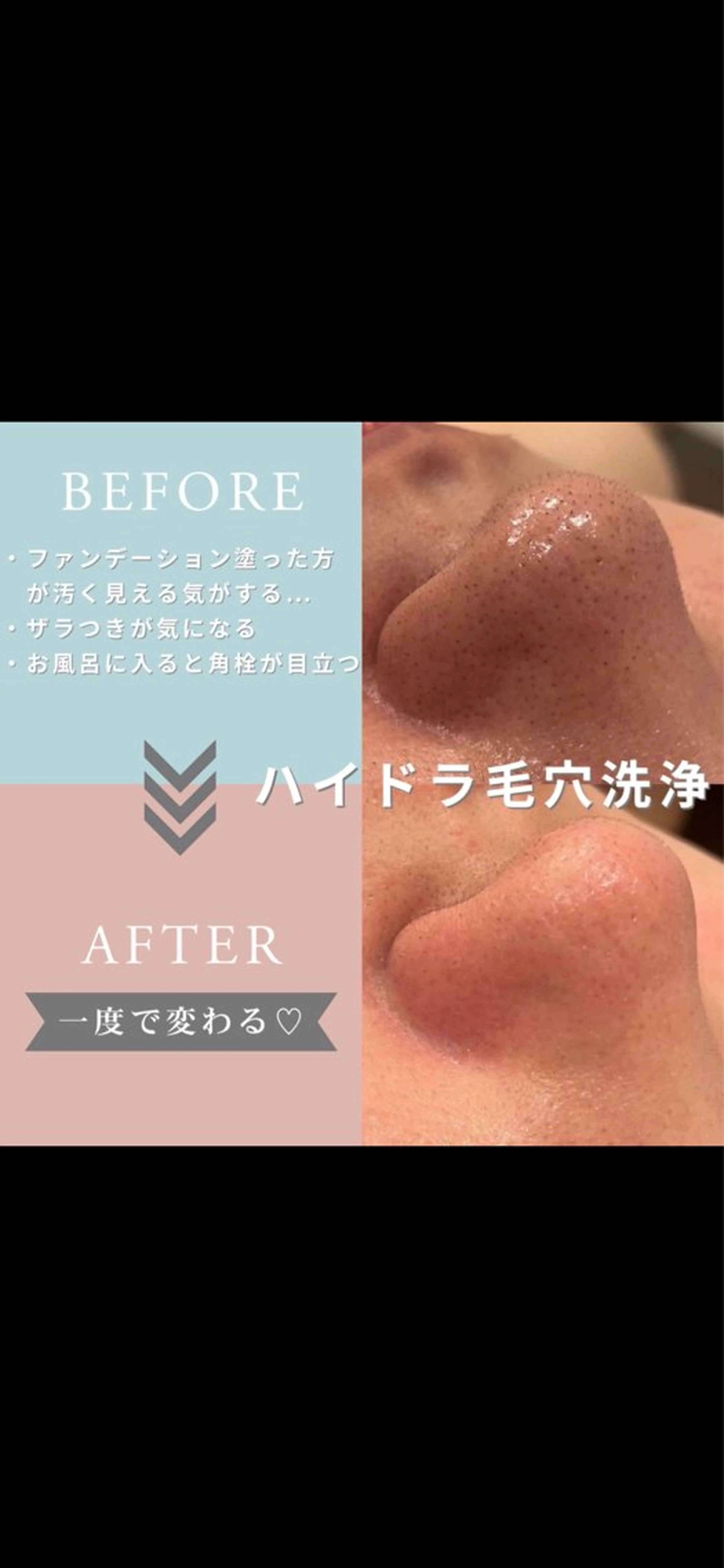 新登場！美容液毛穴洗浄（全顔）の写真