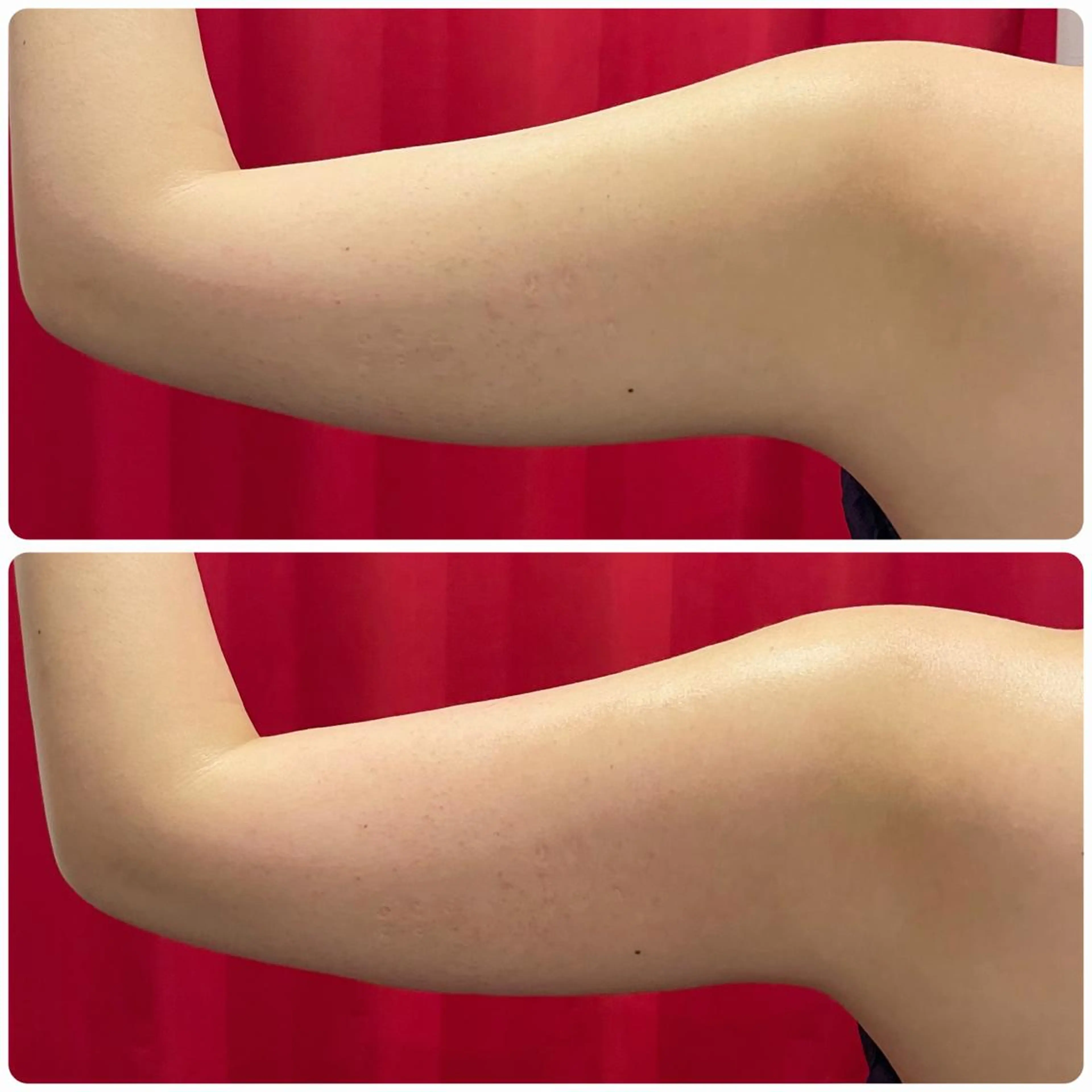 【迷ったらコレ】引き締めたい背中、二の腕痩せハイパーナイフex🔥肩凝りや頭痛にもアプローチします😇の写真