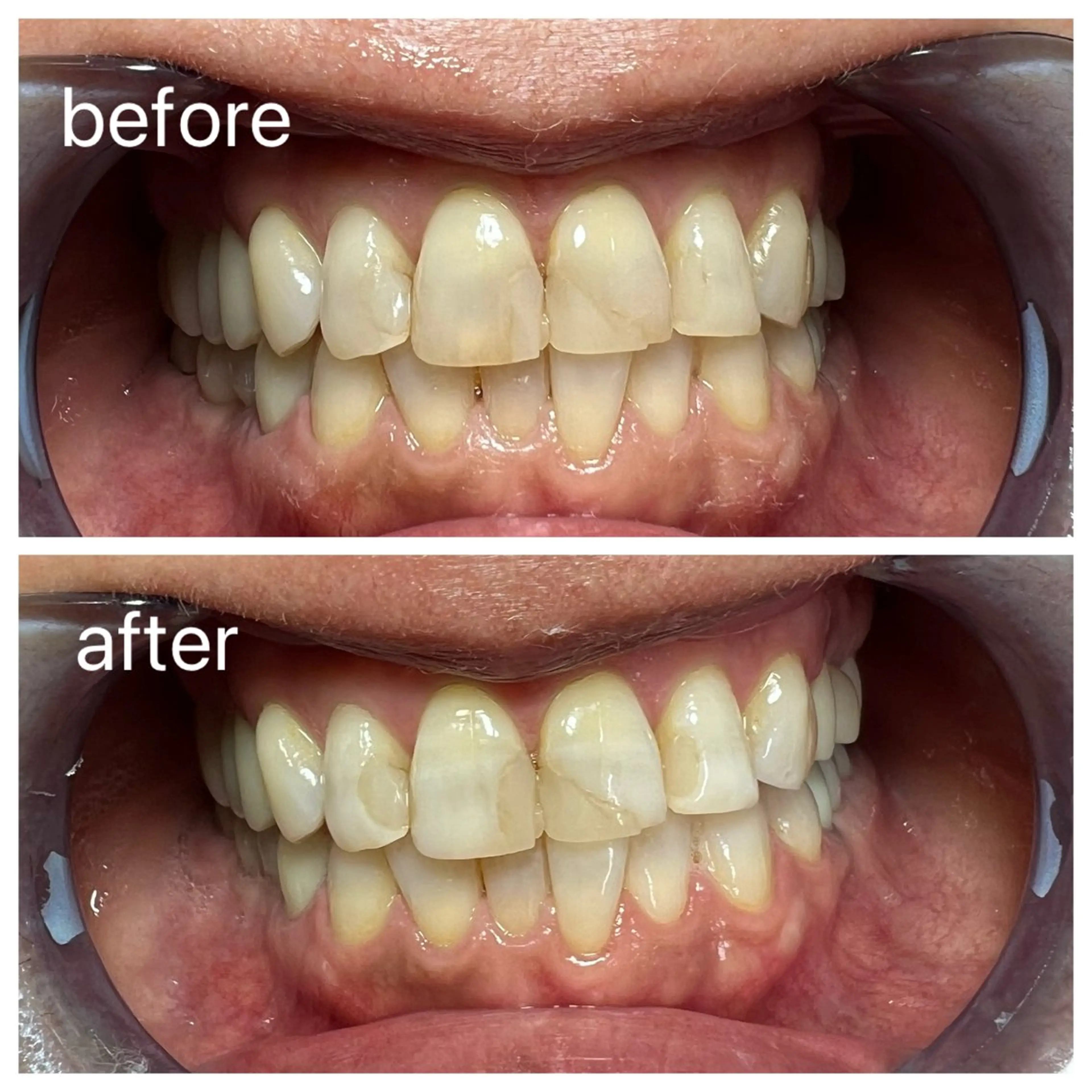 セルフホワイトニング Shineeのエステ・リラクイメージ