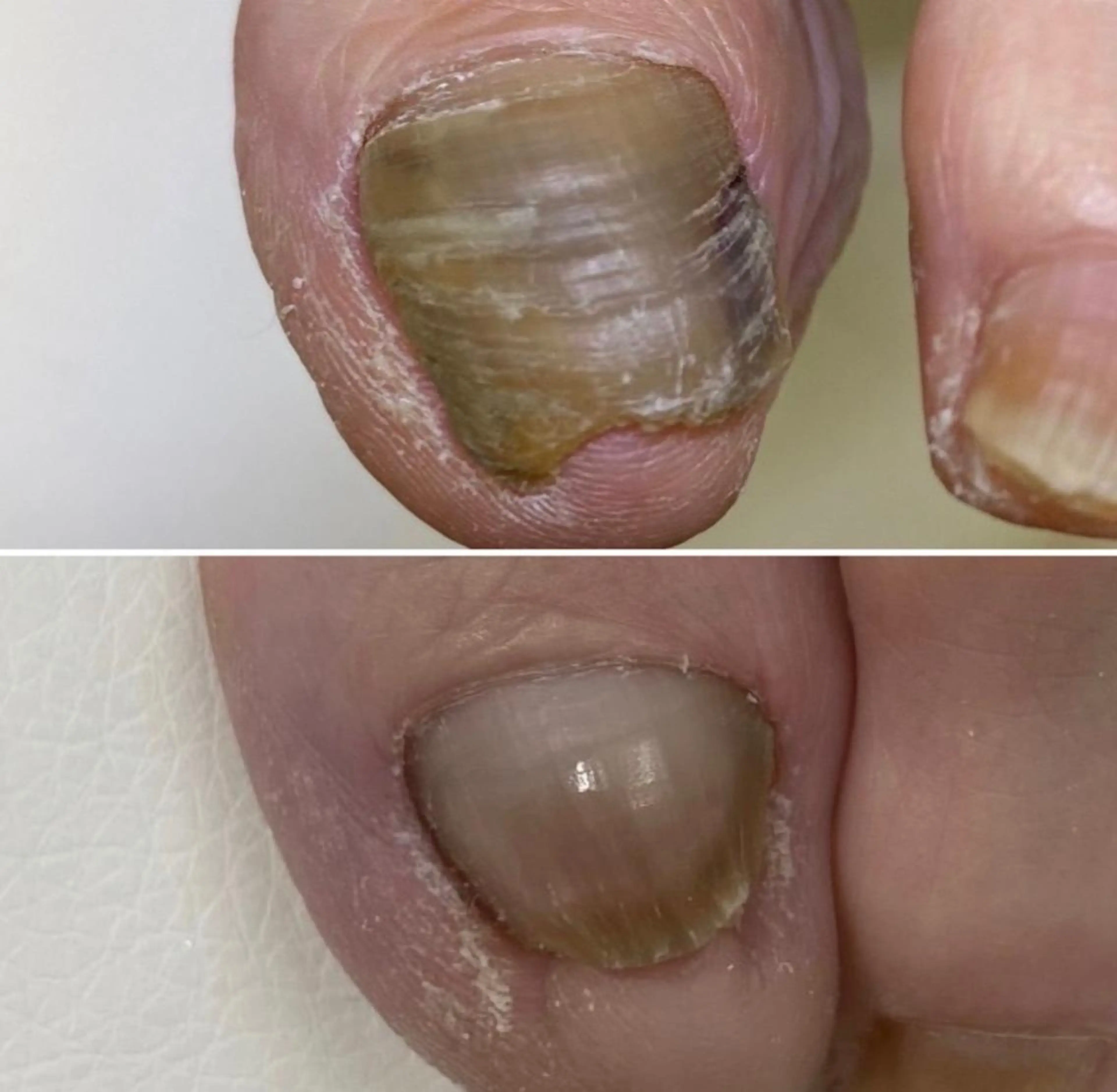 変形爪の再生補正モデルさんの写真