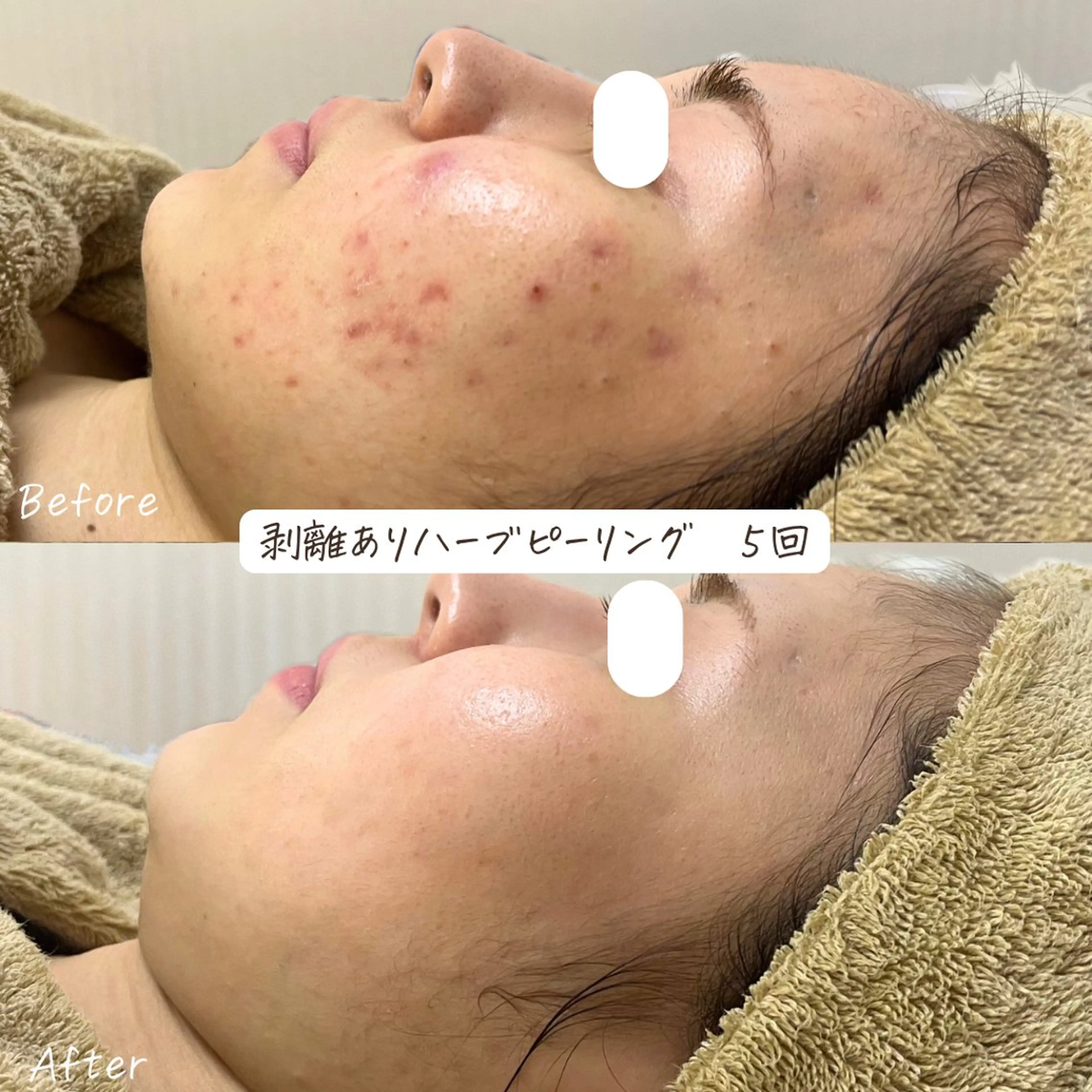 肌質改善サロン renew/ｳｴｷのエステ・リラクイメージ