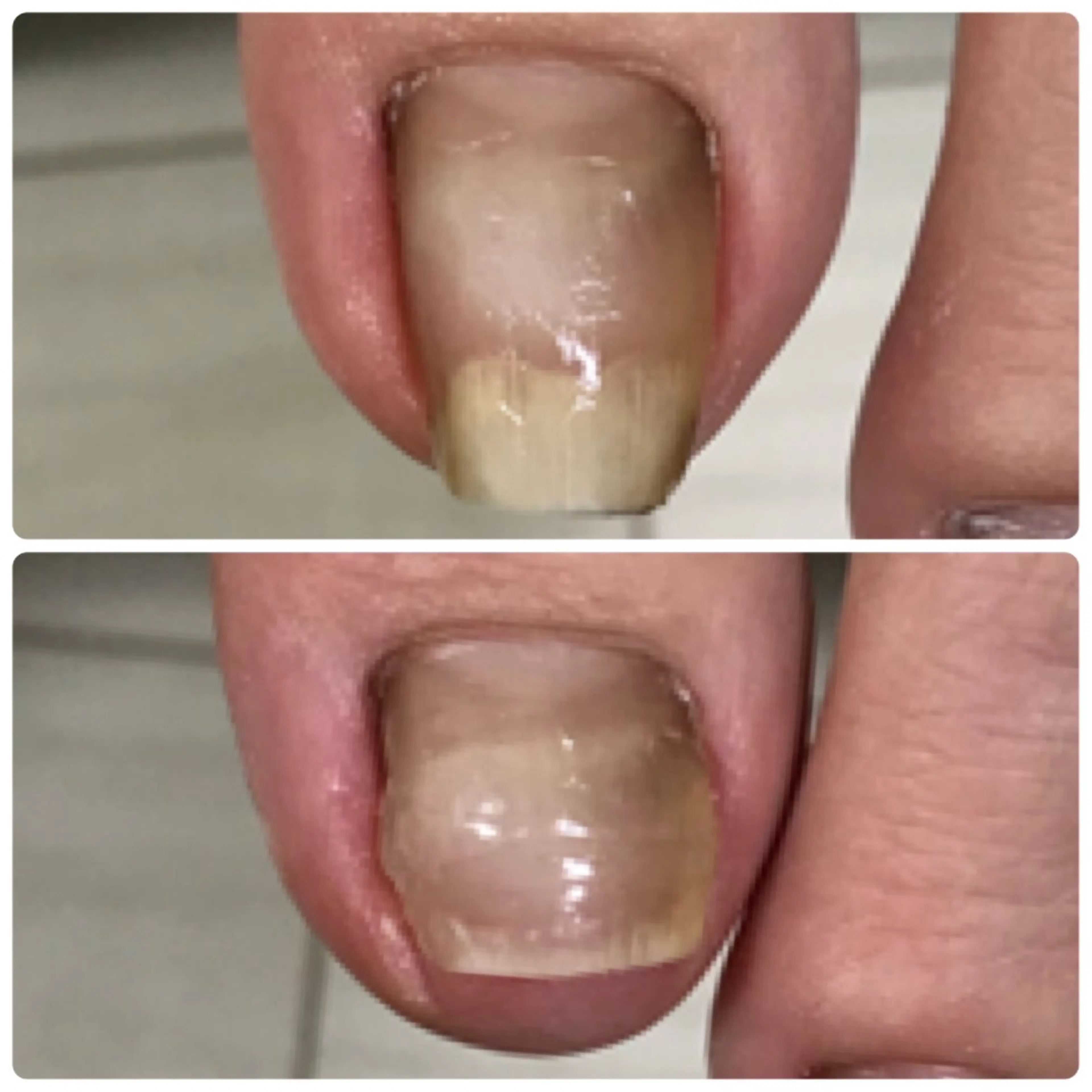 フット巻き爪矯正【¥8,000→¥5,000】ケア付きの写真