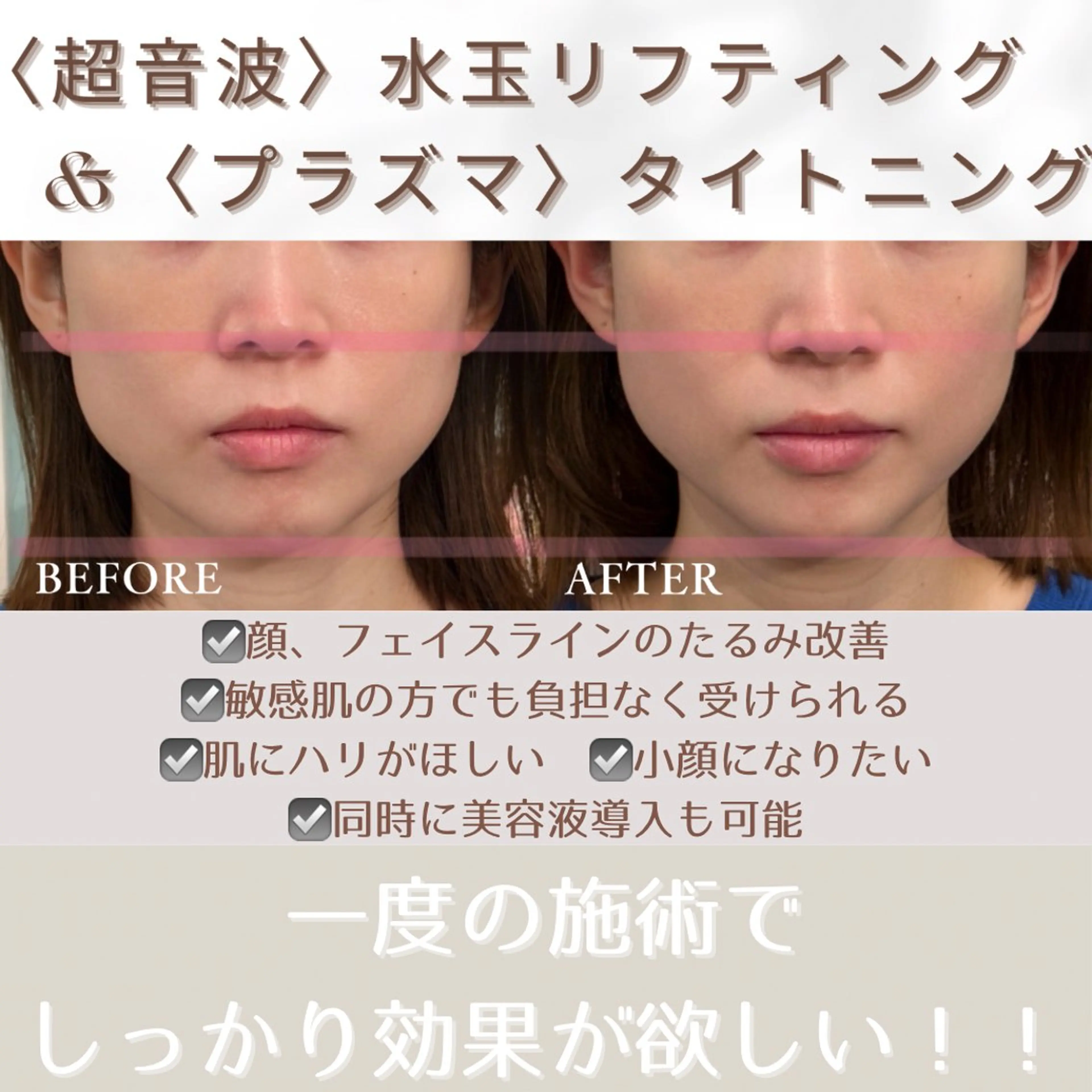 《お写真モニター募集》【超音波】水玉トリプルリフティング+【プラズマ】タイトニングの写真