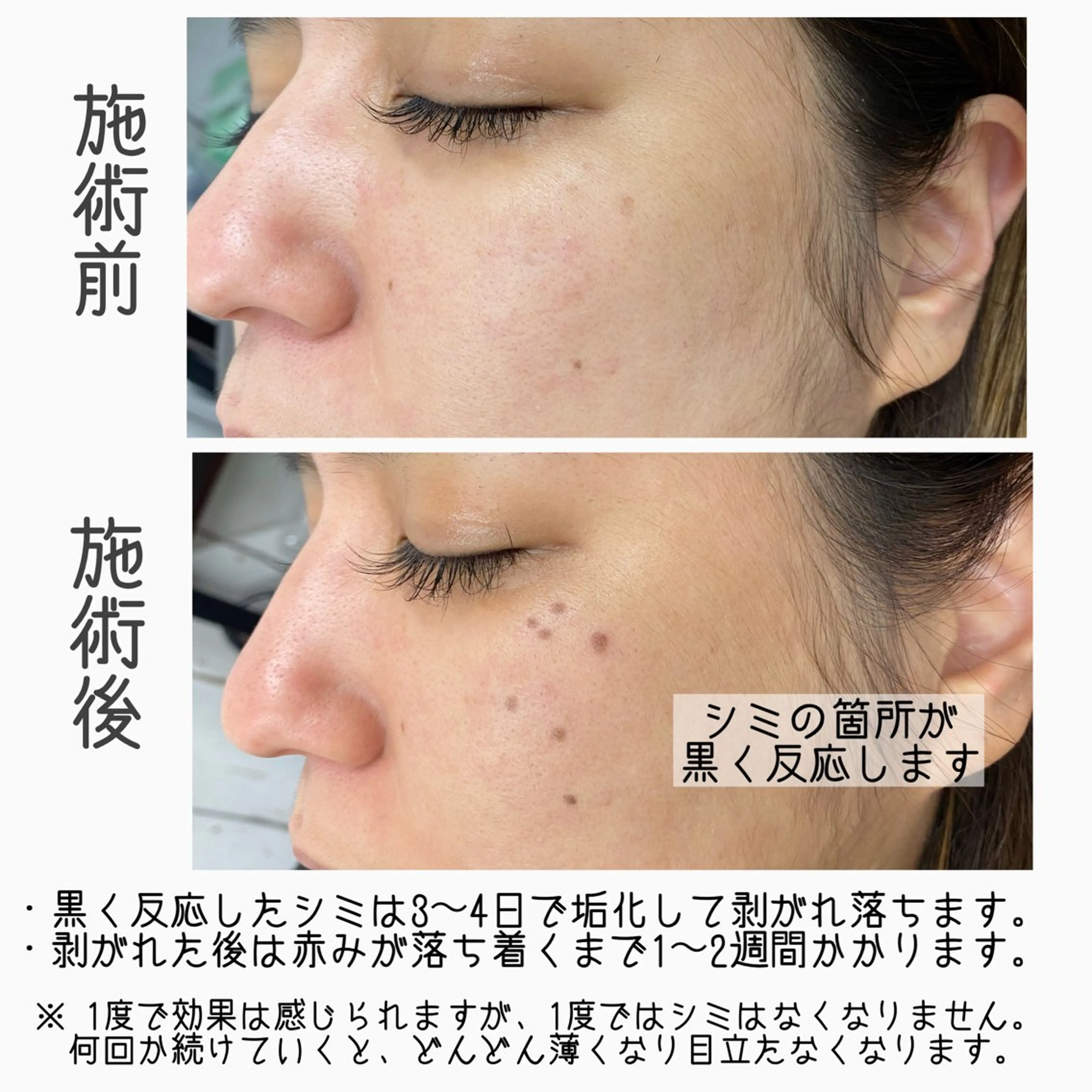 まつ毛パーマ&シミケア（10ショット）の写真