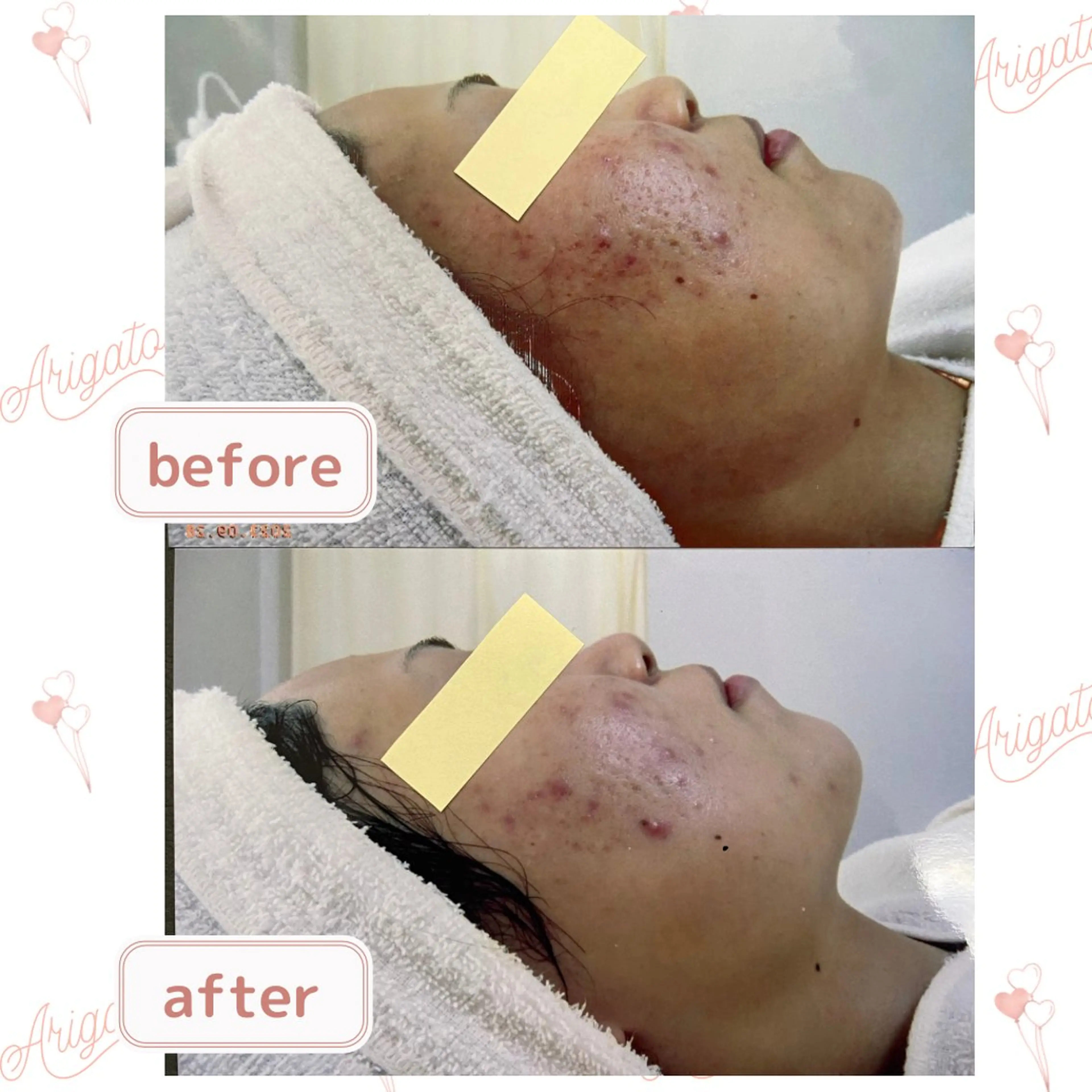 エステ ニキビケア◇ニキビ跡 レゾン京橋店　八崎のエステ・リラクイメージ