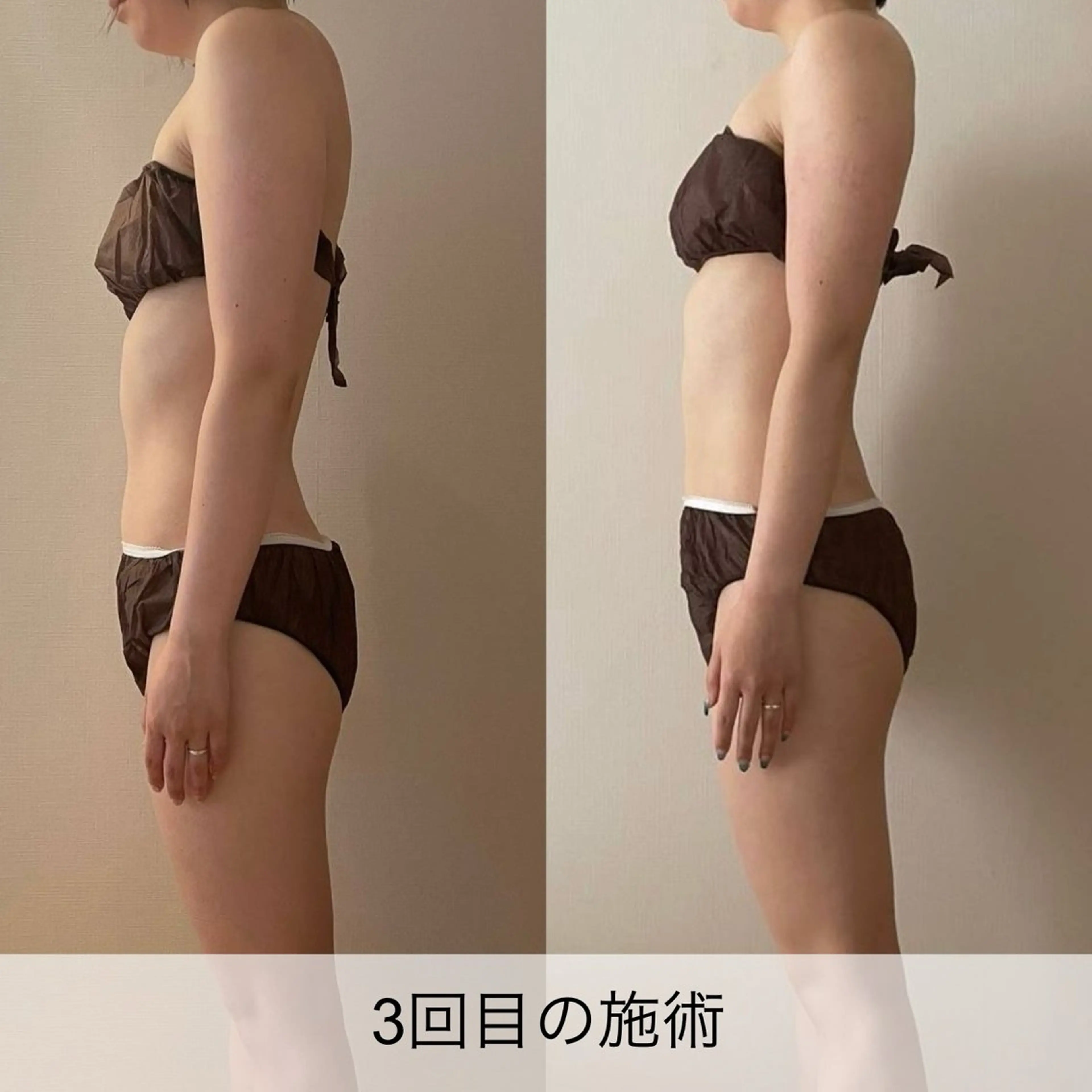 ✨ブライダル前に大人気✨背中・二の腕集中ケアプログラム〈50分〉セルライトゼロ × EMS × オイルリンパ〈50分〉の写真