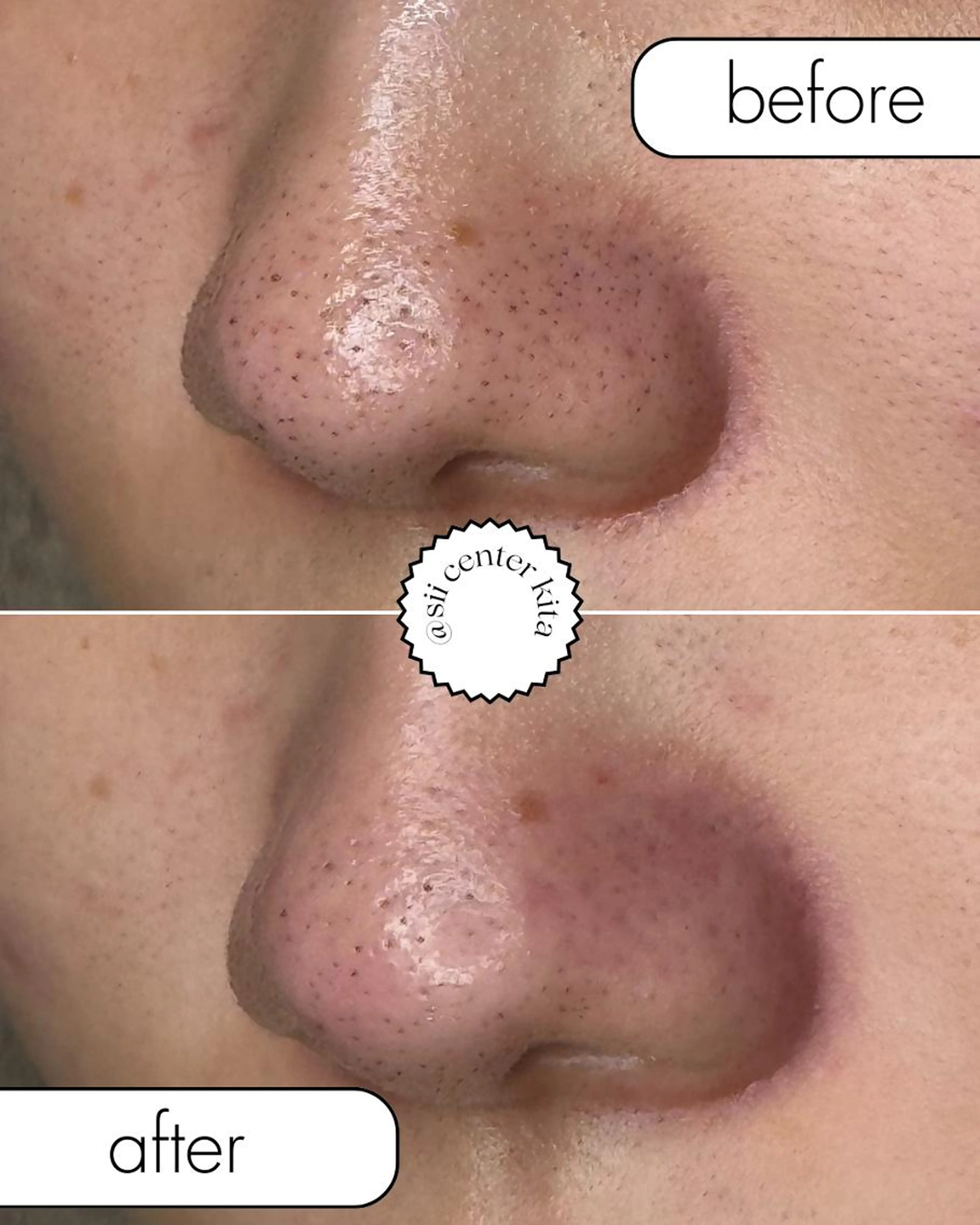 最新毛穴洗浄🫧美容成分を含んだトルネード水流の最新ピーリング💫黒ずみや開き毛穴、お肌のゴワつきにも◉水素シャワー付の写真