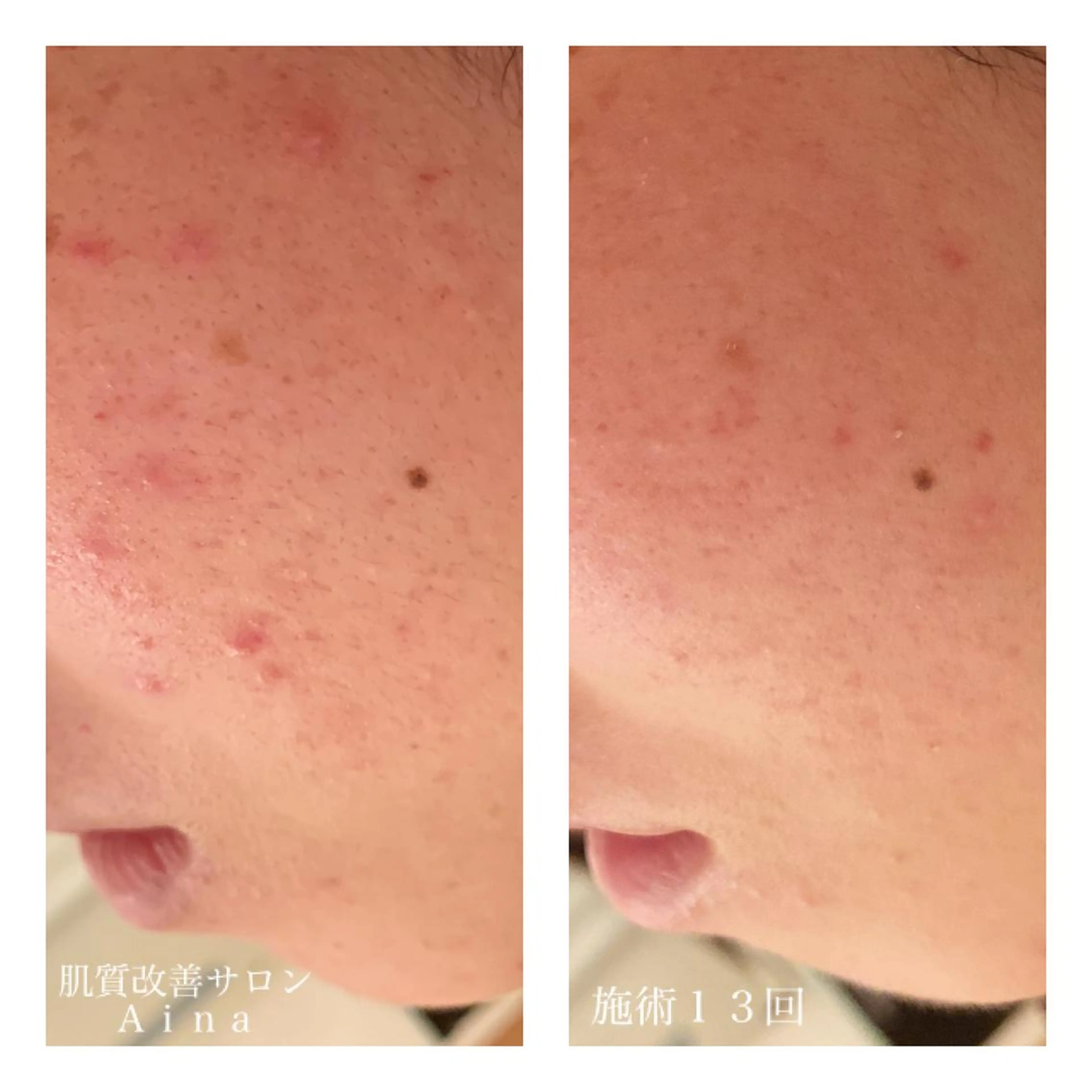 セミロング カラー パーマ ヘアアレンジ メンズ キッズ ネイル マツエク・マツパ エステ リラク ニキビ跡専門サロン Ａｉｎａのエステ・リラクイメージ