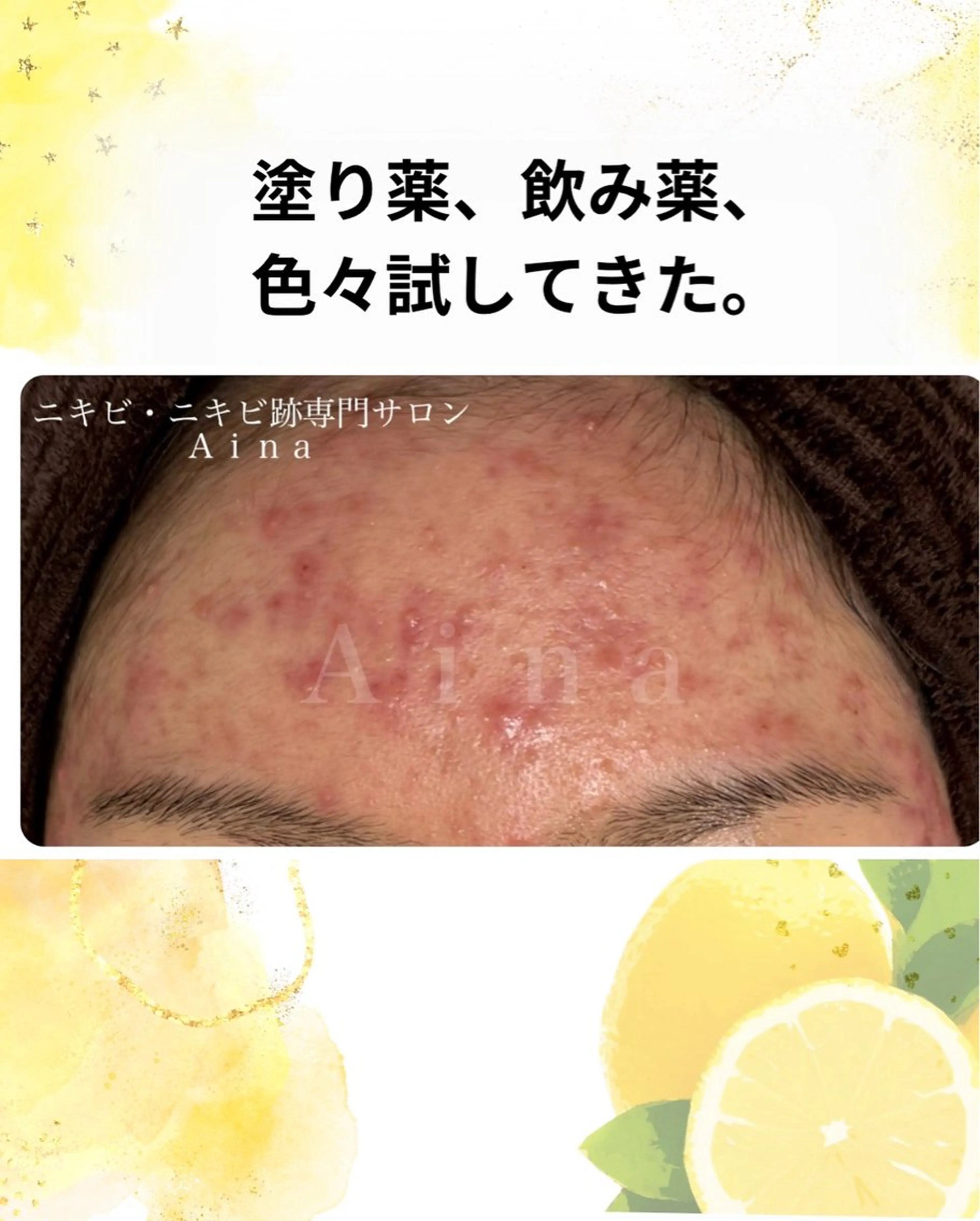 ニキビ跡専門サロン Ainaのエステ・リラクイメージ