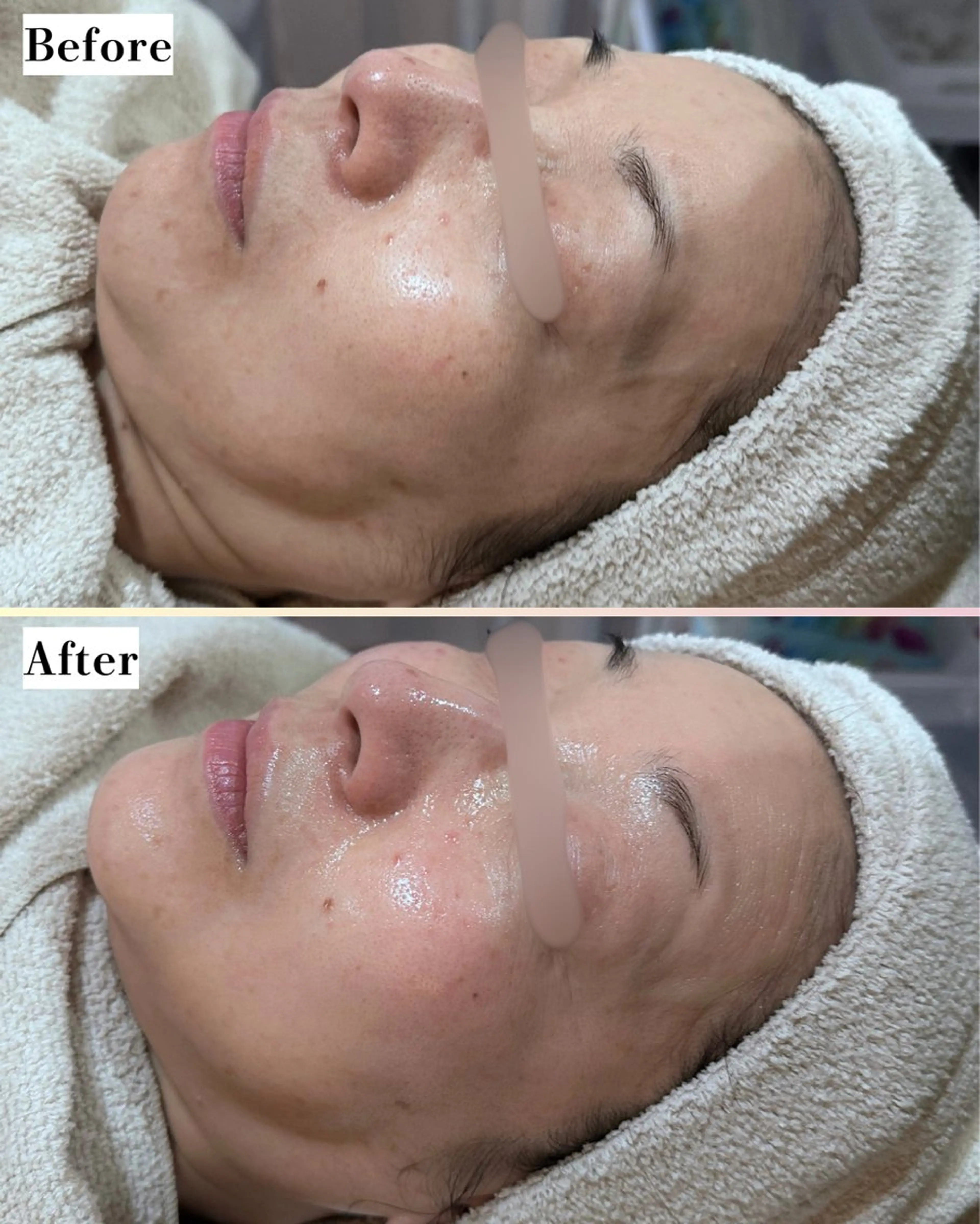 エステ |ピーリング・毛穴| soina神楽坂のエステ・リラクイメージ