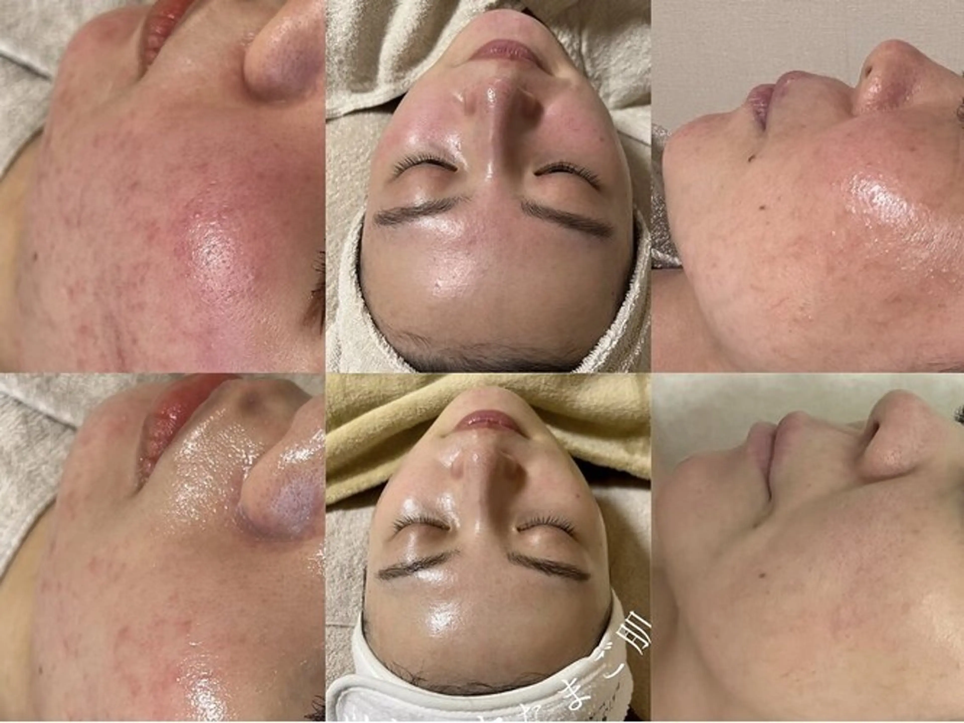 エステ ハーブピーリング専門 毛穴洗浄❤️眉waxのエステ・リラクイメージ