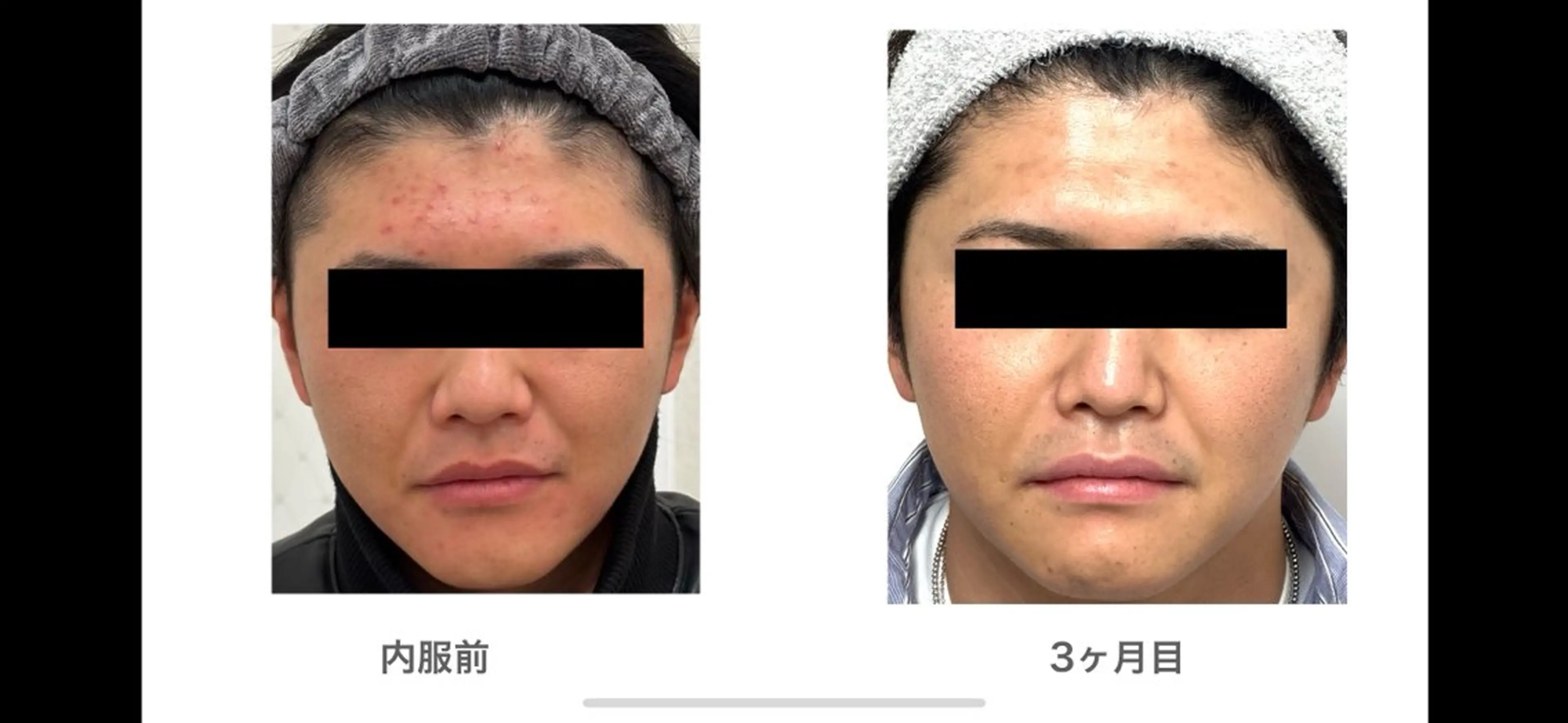 【赤ニキビ改善】 BELL'ET新宿店のエステ・リラクイメージ