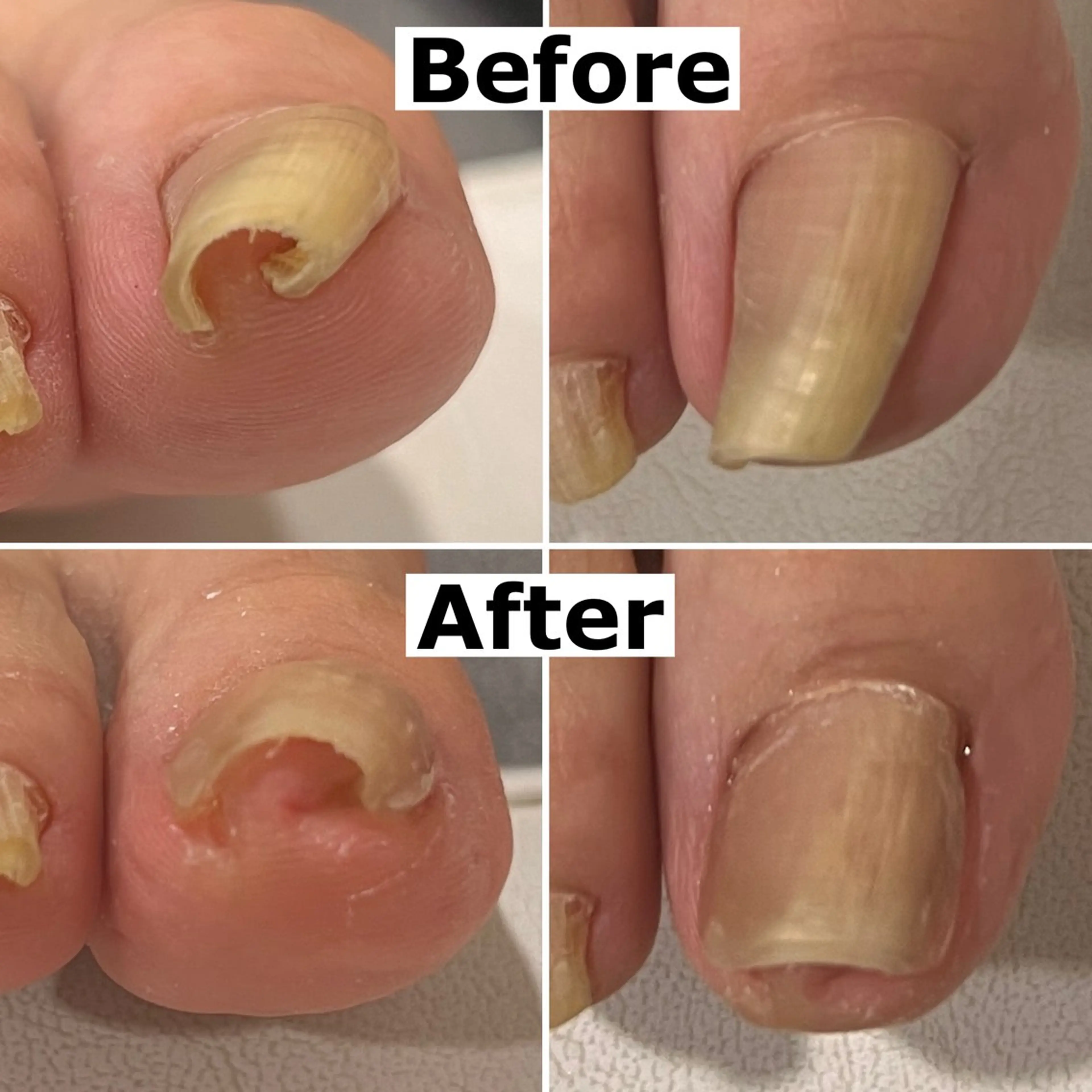 ネイル Mellow nail所属・巻爪無料モデル募集 ✨🦶MEGUMIのネイルデザイン