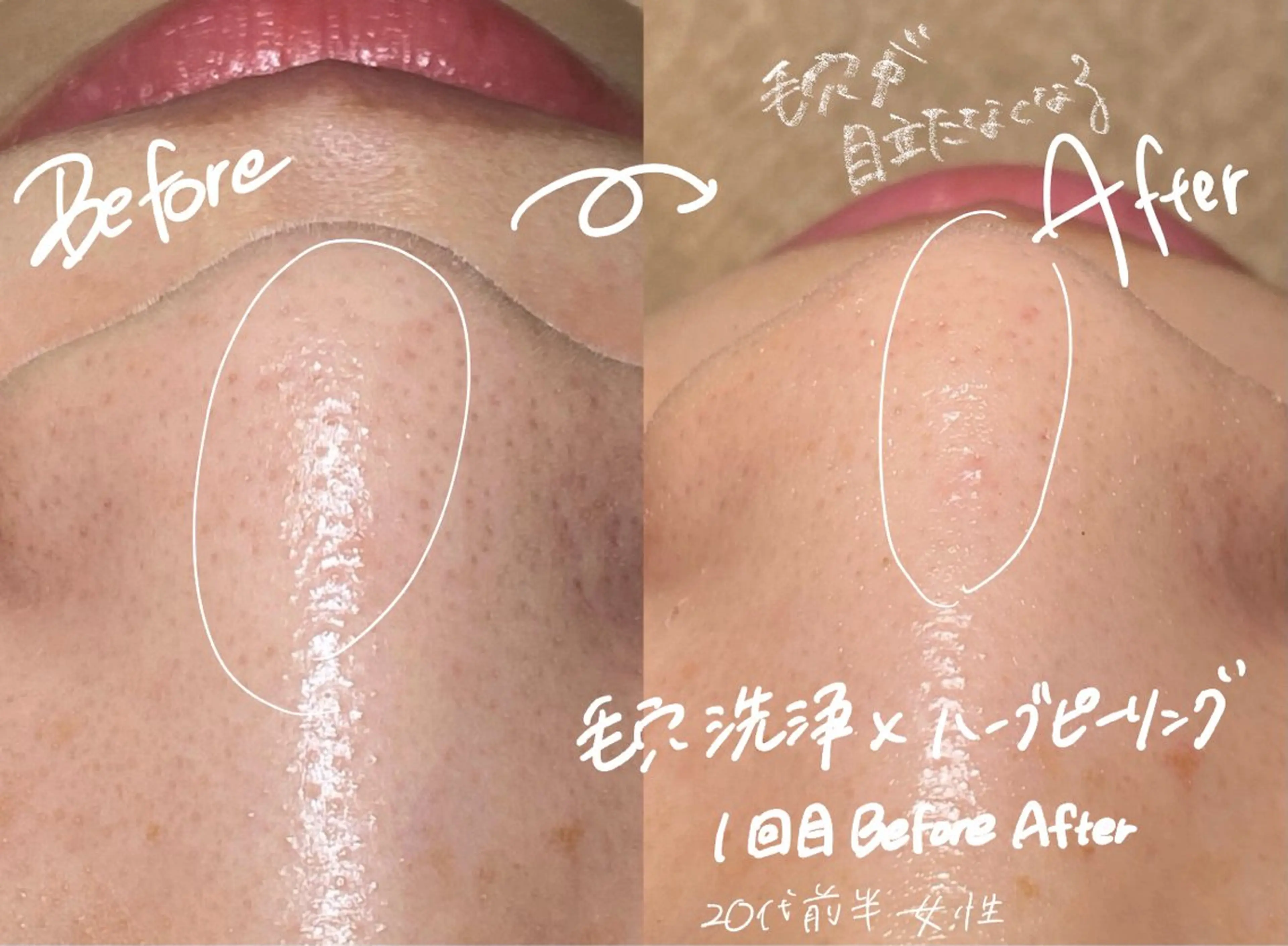 【肌質改善🌿人気NO２】全顔剥離なしハーブピーリング+毛穴洗浄鼻のみ　50分￥7000→￥5000の写真