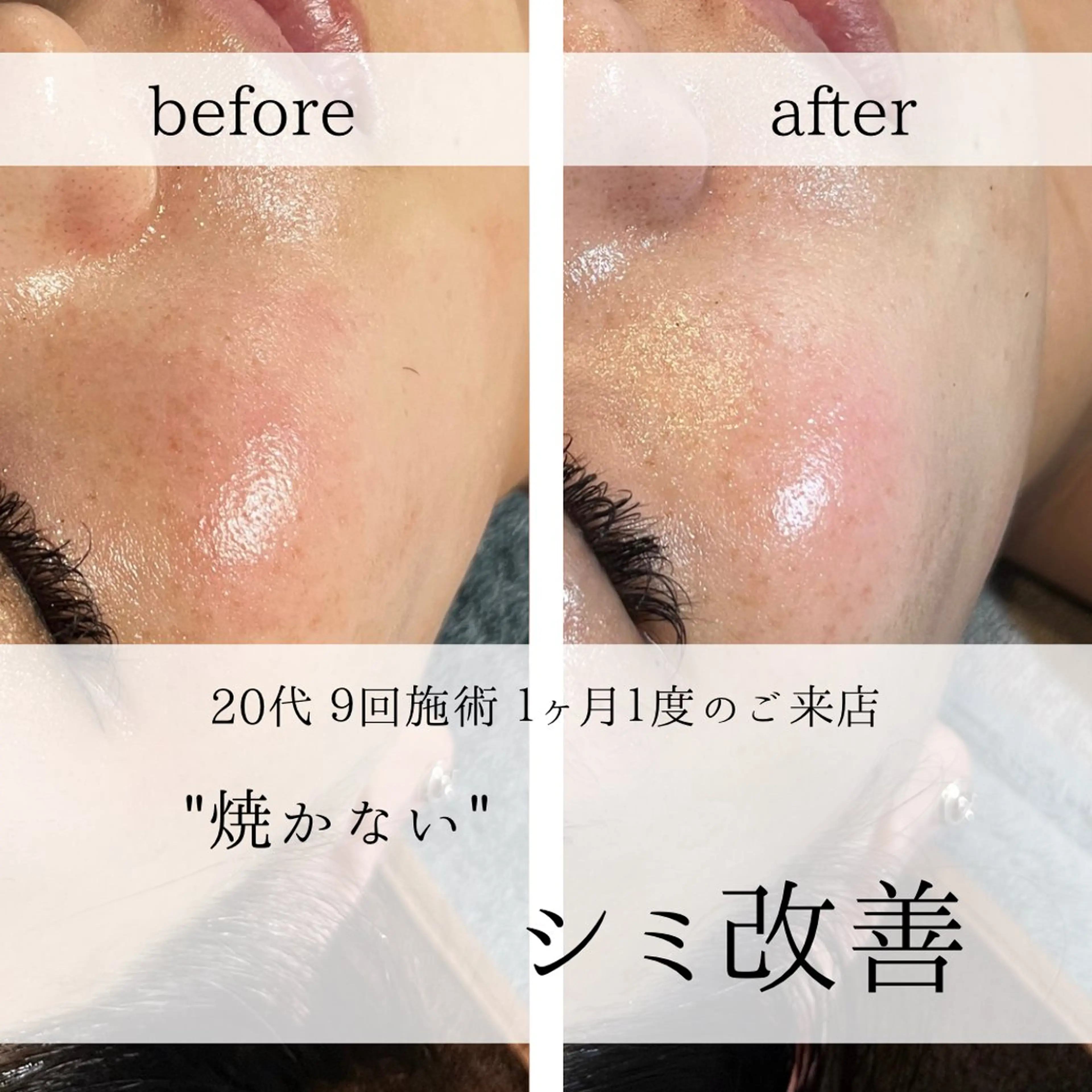 yc.hacci 【ハーブピーリング】の眉毛・アイブロウイメージ